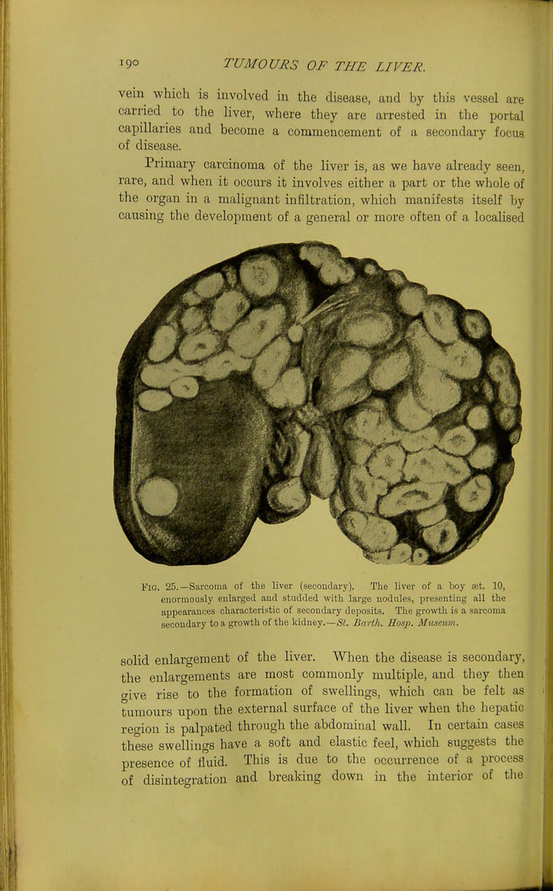 vein which is involved in the disease, and by this vessel are carried to the liver, where they are arrested in the portal capillaries and become a commencement of a secondary focus of disease. Primary carcinoma of the liver is, as we have already seen, rare, and when it occurs it involves either a part or the whole of the organ in a malignant infiltration, which manifests itself by causing the development of a general or more often of a localised Fig. 25.—Sarcoma of the liver (secondarj'). The liver of a boy set. 10, enormously enlarged and studded with large nodules, presenting all the appearances characteristic of secondary deposits. The growth is a sarcoma secondary to a growth of the kidney.—St. Earth. Hosp. Museuyn. solid enlargement of the liver. When the disease is secondary, the enlargements are most commonly multiple, and they then c/ive rise to the formation of swellings, which can be felt as tumours upon the external surface of the liver when the hepatic region is palpated through the abdominal wall. In certain cases these swellings have a soft and elastic feel, which suggests the presence of fluid. This is due to the occurrence of a process of disintegration and breaking down in the interior of tlie