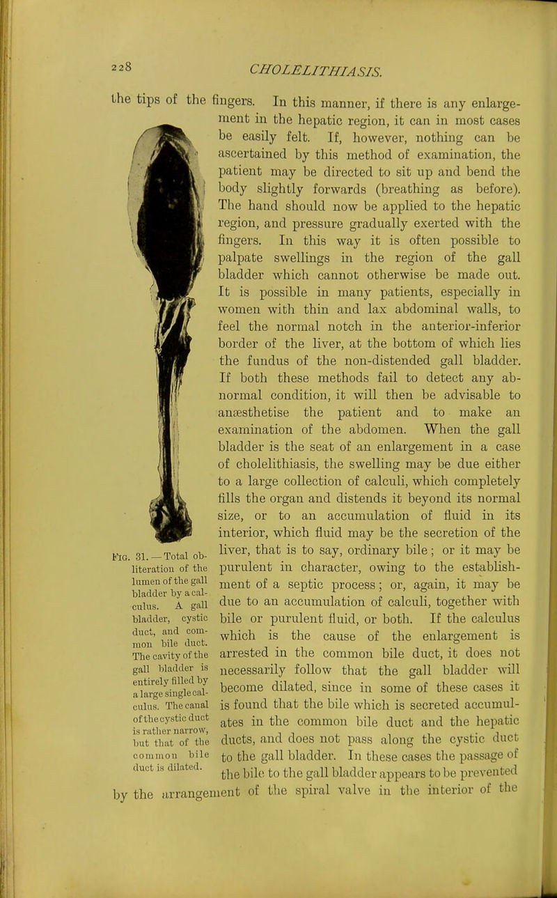 the tips of the fingers. In this manner, if there is any enlarge- ment in the hepatic region, it can in most cases be easily felt. If, however, nothing can be ascertained by this method of examination, the patient may be directed to sit up and bend the body slightly forwards (breathing as before). The hand should now be applied to the hepatic region, and pressure gradually exerted with the fingers. In this way it is often possible to palpate swellings in the region of the gall bladder which cannot otherwise be made out. It is possible in many patients, especially in women with thin and lax abdominal walls, to feel the normal notch in the anterior-inferior border of the liver, at the bottom of which lies the fundus of the non-distended gall bladder. If both these methods fail to detect any ab- normal condition, it will then be advisable to antEsthetise the patient and to make an examination of the abdomen. When the gall bladder is the seat of an enlargement in a case of cholelithiasis, the swelling may be due either to a large collection of calculi, which completely fills the organ and distends it beyond its normal size, or to an accumulation of fluid in its interior, which fluid may be the secretion of the liver, that is to say, ordinary bile; or it may be purulent in character, owing to the establish- ment of a septic process; or, again, it may be due to an accumulation of calculi, together with bile or purulent fluid, or both. If the calculus which is the cause of the enlargement is arrested in the common bile duct, it does not necessarily follow that the gall bladder will become dilated, since in some of these cases it is found that the bile which is secreted accumul- ates in the common bile duct and the hepatic ducts, and does not pass along the cystic duct to the gall bladder. In these cases the passage of the bile to the gall bladder appears to be prevented of the spiral valve in the interior of the t'iG. .31.—Total ob- literation of the lumen of the gall bladder by a cal- culus. A gall bladder, cystic duct, and com- mon bile duct. The cavity of the gall bladder is entirely filled by a large single cal- culus. The canal of the cystic duct is rather narrow, but that of the common bile duct is dilated. by the arrangement