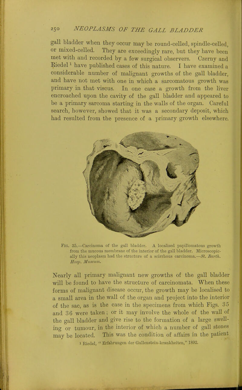 gall bladder when they occur may be round-celled, spindle-celled, or mixed-celled. They are exceedingly rare, but they have been met with and recorded by a few surgical observers. Czerny and Eiedel ^ have published cases of this nature. I have examined a considerable number of malignant growths of the gall bladder, and have not met with one in which a sarcomatous growth was primary in that viscus. In one case a growth from the liver encroached upon the cavity of the gall bladder and appeared to be a primary sarcoma starting in the walls of the organ. Careful search, however, showed that it was a secondary deposit, which had resu.lted from the presence of a primary growth elsewhere. Fig. 35.—Carcinoma of the gall bladder. A localised papillomatous growth from the mucous membrane of the interior of the gall bladder. Microscopic- ally this neoplasm had the structure of a scirrhous carcinoma.—St. Barth. Hos]}. Museum. Nearly all primary malignant new growths of the gall bladder will be found to have the structure of carcinomata. When these forms of malignant disease occur, the growth may be localised to a small area in the wall of the organ and project into the interior of the sac, as is the case in the specimens from which Figs. 35 and .3 6 were taken; or it may involve the whole of the wall of the gall bladder and give rise to the formation of a large swell- ing or tumour, in the interior of which a number of gall stones may be located. This was the condition of affairs in the patient 1 Riedel,  Brfahruugeu der Gnllenstein-krnnkheiten, 1892.