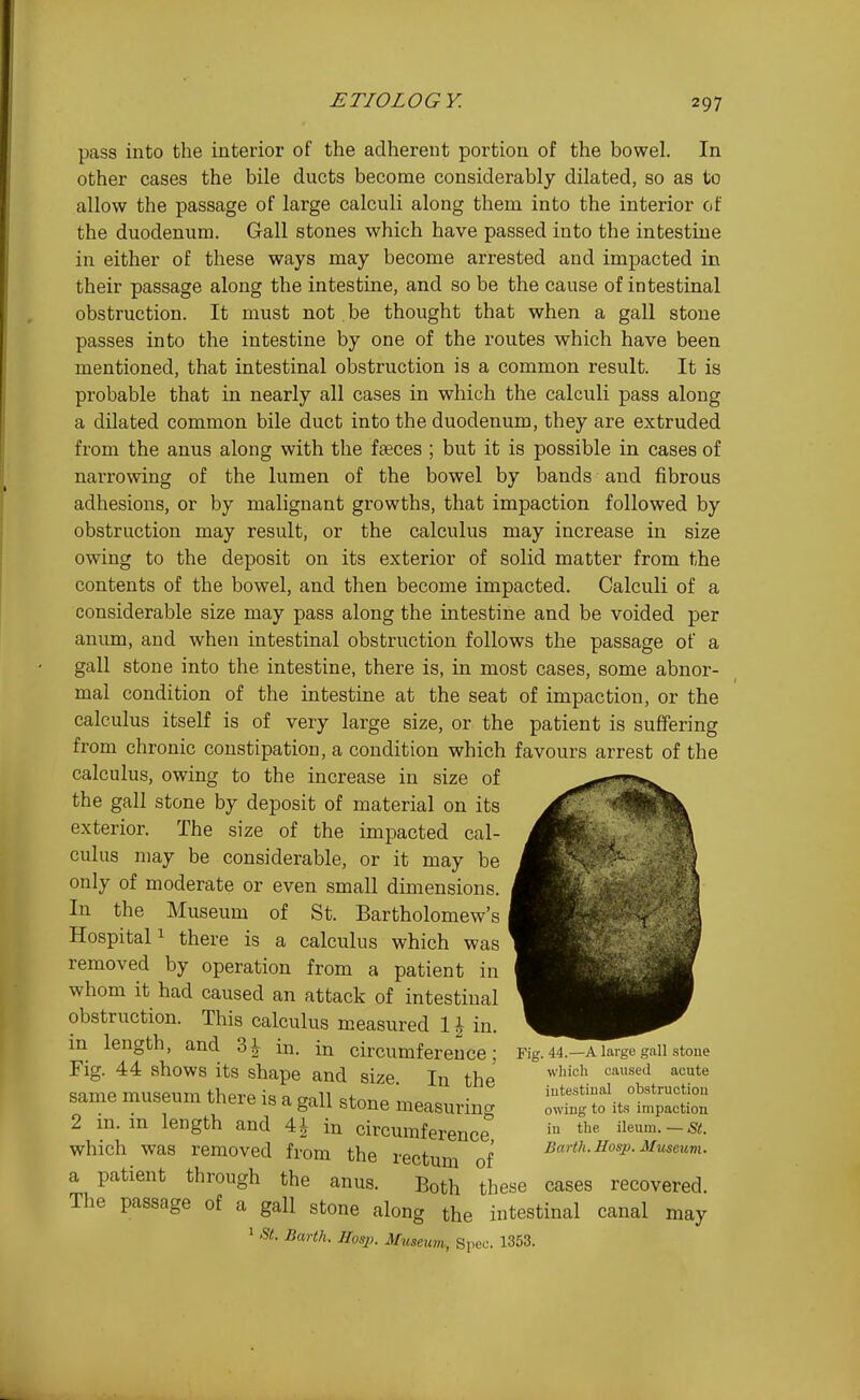 pass into the interior of the adherent portion of the bowel. In other cases the bile ducts become considerably dilated, so as to allow the passage of large calculi along them into the interior of the duodenum. G-all stones which have passed into the intestine in either of these ways may become arrested and impacted in their passage along the intestine, and so be the cause of intestinal obstruction. It must not. be thought that when a gall stone passes into the intestine by one of the routes which have been mentioned, that intestinal obstruction is a common result. It is probable that in nearly all cases in which the calculi pass along a dilated common bile duct into the duodenum, they are extruded from the anus along with the fseces ; but it is possible in cases of narrowing of the lumen of the bowel by bands and fibrous adhesions, or by malignant growths, that impaction followed by obstruction may result, or the calculus may increase in size owing to the deposit on its exterior of solid matter from the contents of the bowel, and then become impacted. Calculi of a considerable size may pass along the intestine and be voided per anum, and when intestinal obstruction follows the passage of a gall stone into the intestine, there is, in most cases, some abnor- mal condition of the intestine at the seat of impaction, or the calculus itself is of very large size, or the patient is suffering from chronic constipation, a condition which favours arrest of the calculus, owing to the increase in size of the gall stone by deposit of material on its exterior. The size of the impacted cal- culus may be considerable, or it may be only of moderate or even small dimensions. In the Museum of St. Bartholomew's Hospital 1 there is a calculus which was removed by operation from a patient in whom it had caused an attack of intestinal obstruction. This calculus measured \\ in. in length, and 31 in. in circumference; Fig. 44 shows its shape and size. In the same museum there is a gall stone measurino- 2 in. in length and 4^ in circumference which was removed from the rectum of a patient through the anus. Both these cases recovered. The passage of a gall stone along the intestinal canal may 1 -a. Earth. Hosp. Museum, Spec. 1353. Fig. 44.—A large gall stoue which caused acute intestinal obstruction owing to its impaction in the ileum. — St. Earth. Hosp. Museum.