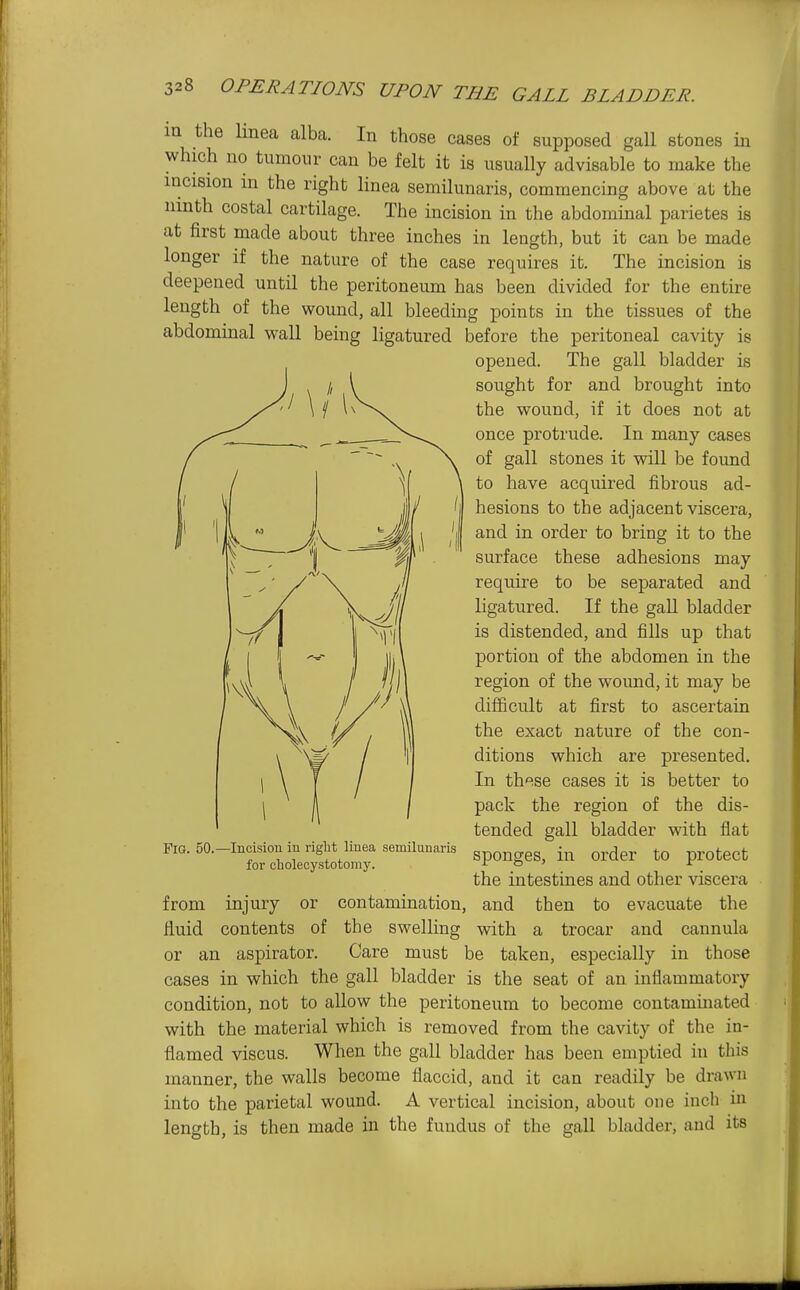 m the Imea alba. In those cases of supposed gall stones m which no tumour can be felt it is usually advisable to make the incision in the right linea semilunaris, commencing above at the ninth costal cartilage. The incision in the abdominal parietes is at first made about three inches in length, but it can be made longer if the nature of the case requires it. The incision is deepened until the peritoneum has been divided for the entire length of the wound, all bleeding points in the tissues of the abdominal wall being ligatured before the peritoneal cavity is opened. The gall bladder is sought for and brought into the vpound, if it does not at once protrude. In many cases of gall stones it will be found to have acquired fibrous ad- hesions to the adjacent viscera, and in order to bring it to the surface these adhesions may require to be separated and ligatured. If the gall bladder is distended, and fills up that portion of the abdomen in the region of the wound, it may be difficult at first to ascertain the exact nature of the con- ditions which are presented. In these cases it is better to pack the region of the dis- tended gall bladder with flat sponges, in order to protect the intestines and other viscera from injury or contamination, and then to evacuate the fluid contents of the swelling with a trocar and cannula or an aspirator. Care must be taken, especially in those cases in which the gall bladder is the seat of an inflammatory condition, not to allow the peritoneum to become contaminated with the material which is removed from the cavity of the in- flamed viscus. When the gall bladder has been emptied in this manner, the walls become flaccid, and it can readily be drawn into the parietal wound. A vertical incision, about one inch iu length, is then made in the fundus of the gall bladder, and its Fig. 50.—Incision iu right liuea semilunaris for cholecystotomy.