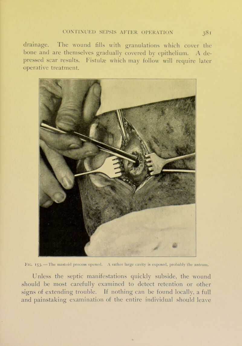 CONTINUED SEPSIS AFTER OPERATION 38] drainage. The wound fills with granulations which cover the bone and arc themselves gradually covered by epithelium. A de- pressed scar results. Fistulae which may follow will require later operative treatment. Fig. 153. — The mastoid process opened. A rather large cavity is exposed, probably the antrum. Unless the septic manifestations quickly subside, the wound should be most carefully examined to detect retention or other sisrns of extending trouble. If nothing can be found locally, a full and painstaking examination of the entire individual should leave