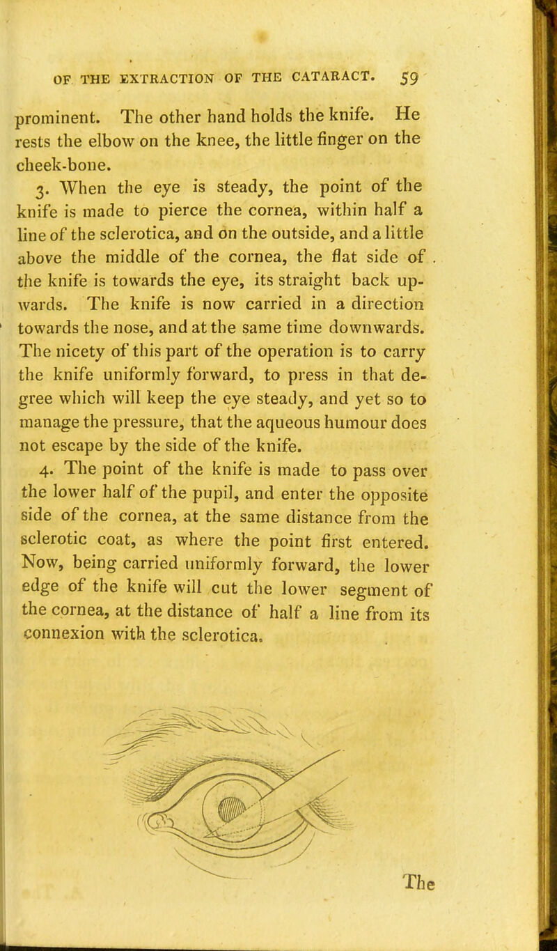 prominent. The other hand holds the knife. He rests the elbow on the knee, the little finger on the cheek-bone. 3. When the eye is steady, the point of the knife is made to pierce the cornea, within half a line of the sclerotica, and on the outside, and a little above the middle of the cornea, the flat side of . the knife is towards the eye, its straight back up- wards. The knife is now carried in a direction towards the nose, and at the same time downwards. The nicety of this part of the operation is to carry the knife uniformly forward, to press in that de- gree which will keep the eye steady, and yet so to manage the pressure, that the aqueous humour does not escape by the side of the knife. 4. The point of the knife is made to pass over the lower half of the pupil, and enter the opposite side of the cornea, at the same distance from the sclerotic coat, as where the point first entered. Now, being carried uniformly forward, the lower edge of the knife will cut the lower segment of the cornea, at the distance of half a line from its connexion with the sclerotica.