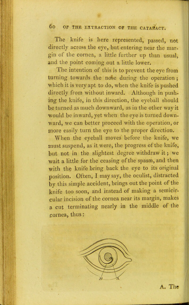 The knife is here represented, passed, not directly across the eye, but entering near the mar- gin of the cornea, a little further up than usual, and the point coming out a little lower. The intention of this is to prevent the eye from turning towards the nose during the operation; which it is very apt to do, when the knife is pushed directly from without inward. Although in push- ing the knife, in this direction, the eyeball should be turned as much downward, as in the other way it would be inward, yet when the eye is turned down- ward, we can better proceed with the operation, or more easily turn the eye to the proper direction. When the eyeball moves before the knife, we must suspend, as it were, the progress of the knife, but not in the slightest degree withdraw it; we wait a little for the ceasing of the spasm, and then with the knife bring back the eye to its original position. Often, I may say, the oculist, distracted by this simple accident, brings out the point of the Jcnife too soon, and instead of making a semicir- cular incision of the cornea near its margin, makes a cut terminating nearly in the middle of the cornea, thus: A. The