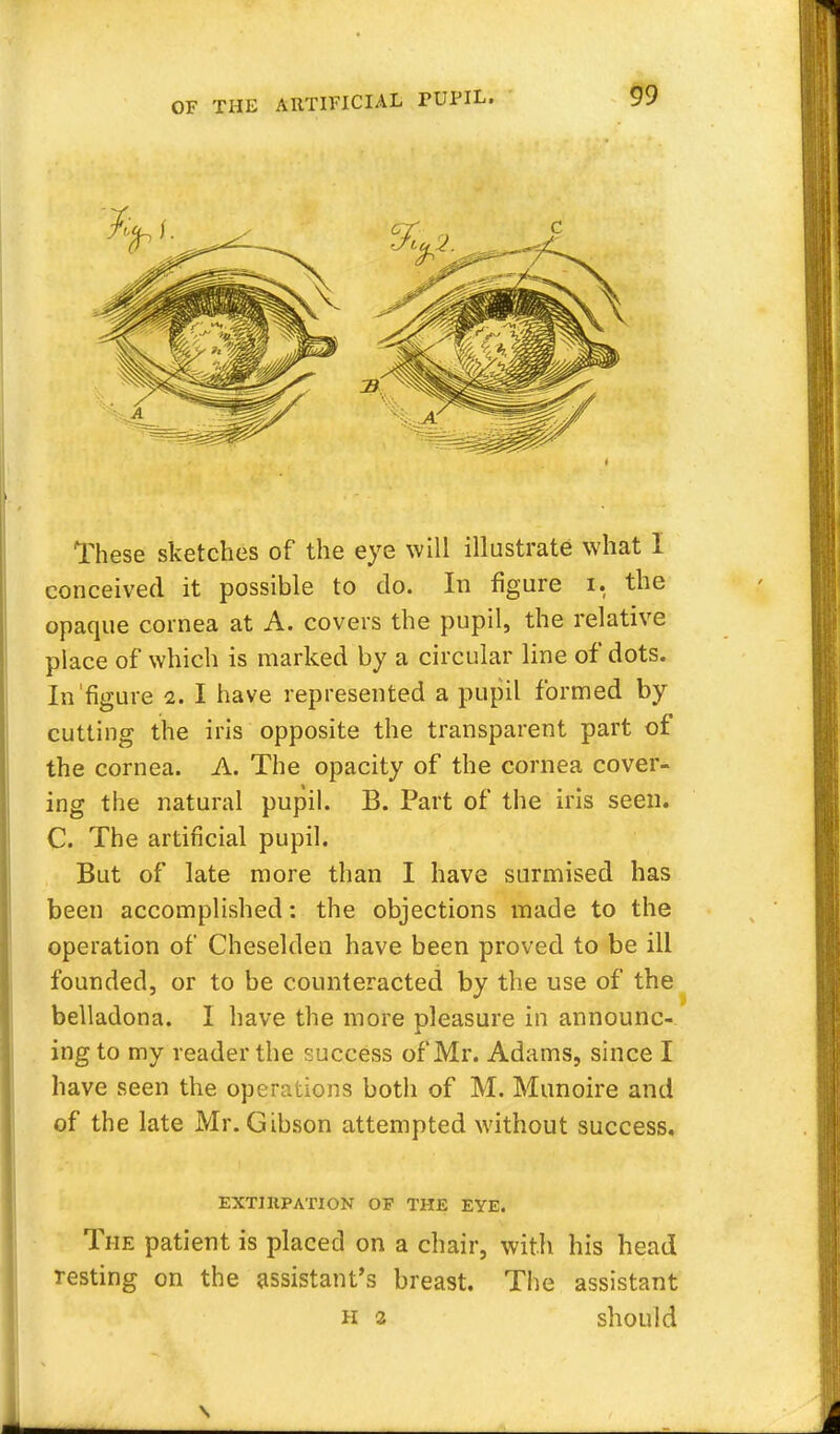 These sketches of the eye will illustrate what I conceived it possible to do. In figure r, the opaque cornea at A. covers the pupil, the relative place of which is marked by a circular line of dots. In'figure i. I have represented a pupil formed by cutting the iris opposite the transparent part of the cornea. A. The opacity of the cornea cover- ing the natural pupil. B. Part of the iris seen. C. The artificial pupil. But of late more than I have surmised has been accomplished: the objections made to the operation of Cheselden have been proved to be ill founded, or to be counteracted by the use of the belladona. I have the more pleasure in announc- ing to my reader the success of Mr. Adams, since I have seen the operations both of M. Munoire and of the late Mr. Gibson attempted without success. EXTIRPATION OF THE EYE. The patient is placed on a chair, with his head resting on the assistant's breast. The assistant h 2 should \
