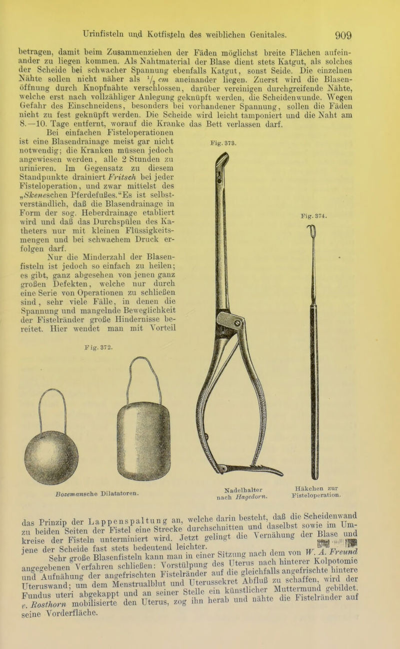 Fig.378. betragen, damit beim Zusammenziehen der Fäden möglichst breite Flächen aufein- ander zu liegen kommen. Als Nahtmaterial der Blase dient stets Katgut, als solches der Scheide bei schwacher Spannung ebenfalls Katgut, sonst Seide. Die einzelnen Nä-hte sollon nicht näher als V2 aneinander liegen. Zuerst wird die Blasen- öffnung durch Kuopfuähte verschlossen, darüber vereinigen durchgreifende Nähte, welche erst nach vollzähliger Anlegung geknüpft werden, die Scheidenwunde. Wegen Gefahr des Einschneidcus, besonders bei vorhandener Spannung, sollen die Fäden nicht zu fest geknüpft werden. Die Scheide wird leicht tamponiert und die Naht am 8.—10. Tage entfernt, worauf die Kranke das Bett verlassen darf. Bei einfachen Fisteloperationen ist eine Blasendrainage meist gar nicht notwendig; die Kranken müssen jedoch angewiesen werden, alle 2 Stunden zu urinieren. Im Gegensatz zu diesem Standpunkte drainiert Fritsch bei jeder Fisteloperation, und zwar mittelst des „8Ä;e«escheu Pferdefußes.Es ist selbst- verständlich, daß die Blasendrainage in Form der sog. Heberdrainage etabliert wird und daß das Durchspülen des Ka- theters nur mit kleinen Flüssigkeits- mengen und bei schwachem Druck er- folgen darf. Nur die Minderzahl der Blasen- fisteln ist jedoch so einfach zu heilen; es gibt, ganz abgesehen von jenen ganz großen Defekten, welche nur durch eine Serie von Operationen zu schließen sind, sehr viele Fälle, in denen die Spannung und mangelnde Beweglichkeit der Fistelräuder große Hindernisse be- reitet. Hier wendet man mit Vorteil Fig. 372. Fig.374. Bozemansche Dilatatoren. Nadolhalter nach Hagedorn. frilkclion 7AIT Fistülopcration. kreise der Fisteln untermi.iiert wird. Jetzt gelinst die \ er„»hu„g der Bkse .md aogegebäL'Verfahre,. .cMie«e,.: Vor^a.p.ng des und Aufiiähung der angefrischteii Fistelrimder a,iil ic S'J,, „ ' ri,»ffc,, „ird der mer„s«„d; „.^ dem Monstn.a Id,,. ,,,ul Ute^^^ M^tt«d rÄr 'jS d» uJe^m iin hiralr'nnd nal.te die Fistelrander a,.r seine Vorderfläche.