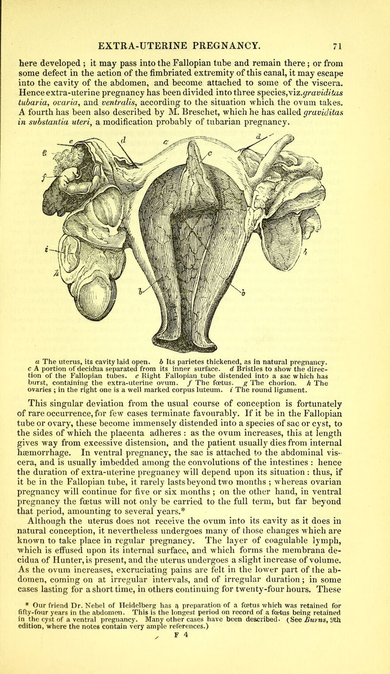 here developed ; it may pass into the Fallopian tube arid remain there ; or from some defect in the action of the fimbriated extremity of this canal, it may escape into the cavity of the abdomen, and become attached to some of the viscera. Hence extra-uterine pregnancy has been divided into three s\)ecies,viz.graviditas tubaria, ovaria, and ventralis, according to the situation which the ovum takes. A fourth has been also described by M. Breschet, which he has called graviditas in substantia uteri, a modification probably of tubarian pregnancy. a The uterus, its cavity laid open, b Its parietes thickened, as in natural pregnancy. c A portion of decidua separated from its inner surface, d Bristles to show the direc- tion of the Fallopian tubes, e Right Fallopian tube distended into a sac which has burst, containing the extra-uterine ovum. / The foetus, g The chorion. h The ovaries ; in the right one is a well marked corpus luteum. i The round ligament. This singular deviation from the usual course of conception is fortunately of rare occurrence, for few cases terminate favourably. If it be in the Fallopian tube or ovary, these become immensely distended into a species of sac or cyst, to the sides of which the placenta adheres : as the ovum increases, this at length gives way from excessive distension, and the patient usually dies from internal haemorrhage. In ventral pregnancy, the sac is attached to the abdominal vis- cera, and is usually imbedded among the convolutions of the intestines : hence the duration of extra-uterine pregnancy will depend upon its situation : thus, if it be in the Fallopian tube, it rarely lasts beyond two months ; whereas ovarian pregnancy will continue for five or six months ; on the other hand, in ventral pregnancy the foetus will not only be carried to the full term, but far beyond that period, amounting to several years.* Although the uterus does not receive the ovum into its cavity as it does in natural conception, it nevertheless undergoes many of those changes which are known to take place in regular pregnancy. The layer of coagulable lymph, which is effused upon its internal surface, and which forms the membrana de- cidua of Hunter, is present, and the uterus undergoes a slight increase of volume. As the ovum increases, excruciating pains are felt in the lower part of the ab- domen, coming on at irregular intervals, and of irregular duration; in some cases lasting for a short time, in others continuing for twenty-four hours. These * Our friend Dr. Nebel of Heidelberg has a preparation of a foetus which was retained for fifty-four years in the abdomen. This is the longest period on record of a foetus being retained in the cyst of a ventral pregnancy. Many other cases have been described- (See Burns, 9th edition, where the notes contain very ample references.) . F 4