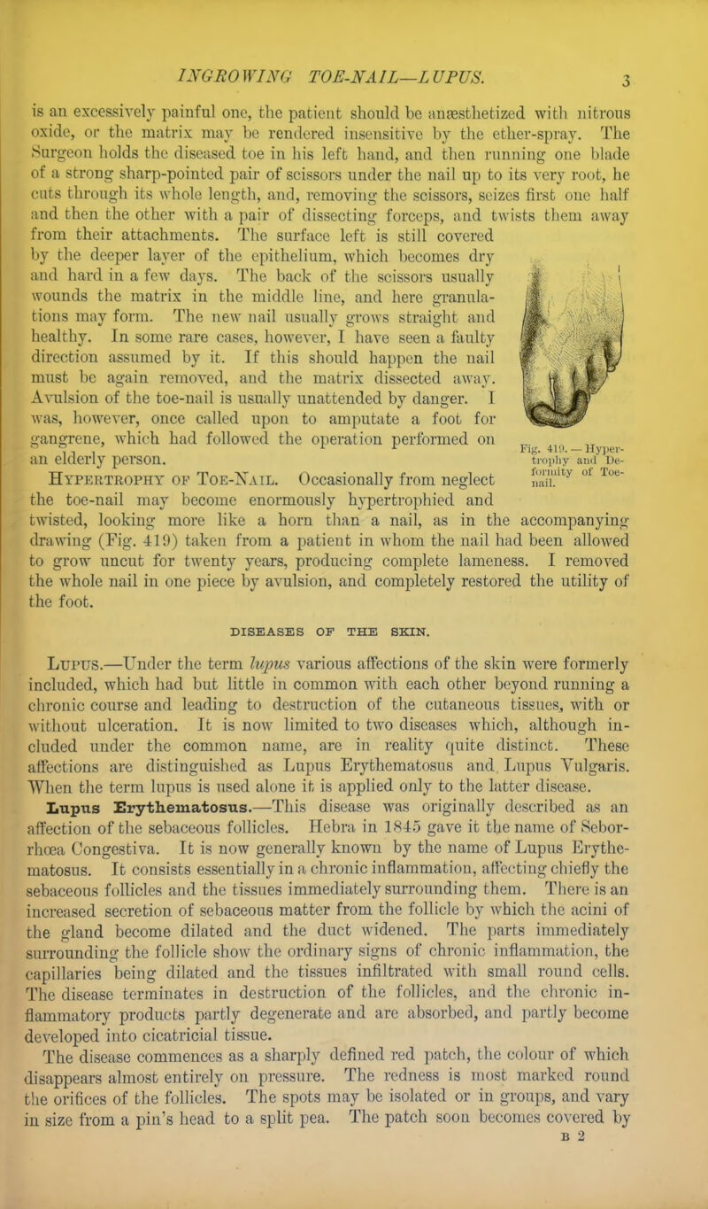 IXGRO WING TOE-NAIL—L UPUS. is an excessively painful one, the patient should be anesthetized with nitrous oxide, or the matrix may be rendered insensitive by the ether-spray. The Surgeon holds the diseased toe in his left hand, and then running one blade of a strong sharp-pointed pair of scissors under the nail up to its very root, he cats through its whole length, and, removing the scissors, seizes first one half and then the other with a pair of dissecting forceps, and twists them away from their attachments. The surface left is still covered by the deeper layer of the epithelium, which becomes dry and hard in a few days. The back of the scissors usually wounds the matrix in the middle line, and here granula- tions may form. The new nail usually grows straight and healthy. In some rare cases, however, I have seen a faulty direction assumed by it. If this should happen the nail must be again removed, and the matrix dissected away. Avulsion of the toe-nail is usually unattended by danger. I was, however, once called upon to amputate a foot for gangrene, which had followed the operation performed on an elderly person. trophy ami' ue- Hypertrophy of Toe-Nail. Occasionally from neglect 01 Tue the toe-nail may become enormously hypertrophied and twisted, looking more like a horn than a nail, as in the accompanying drawing (Fig. 419) taken from a patient in whom the nail had been allowed to grow uncut for twenty years, producing complete lameness. I removed the whole nail in one piece by avulsion, and completely restored the utility of the foot. DISEASES OF THE SKIN. Lupus.—Under the term lupus various affections of the skin were formerly included, which had but little in common with each other beyond running a chronic course and leading to destruction of the cutaneous tissues, with or without ulceration. It is now limited to two diseases which, although in- cluded under the common name, are in reality quite distinct. These affections are distinguished as Lupus Erythematosus and Lupus Vulgaris. When the term lupus is used alone it is applied only to the latter disease. Lupus Erythematosus.—-This disease was originally described as an affection of the sebaceous follicles. Hebra in 1H45 gave it the name of Sebor- rhoea Congestiva. It is now generally known by the name of Lupus Erythe- matosus. It consists essentially in a chronic inflammation, affecting chiefly the sebaceous follicles and the tissues immediately surrounding them. There is an increased secretion of sebaceous matter from the follicle by which the acini of the gland become dilated and the duct widened. The parts immediately surrounding the follicle show the ordinary signs of chronic inflammation, the capillaries being dilated and the tissues infiltrated with small round cells. The disease terminates in destruction of the follicles, and the chronic in- flammatory products partly degenerate and are absorbed, and partly become developed into cicatricial tissue. The disease commences as a sharply defined red patch, the colour of which disappears almost entirely on pressure. The redness is most marked round the orifices of the follicles. The spots may be isolated or in groups, and vary in size from a pin's head to a split pea. The patch soon becomes covered by B 2