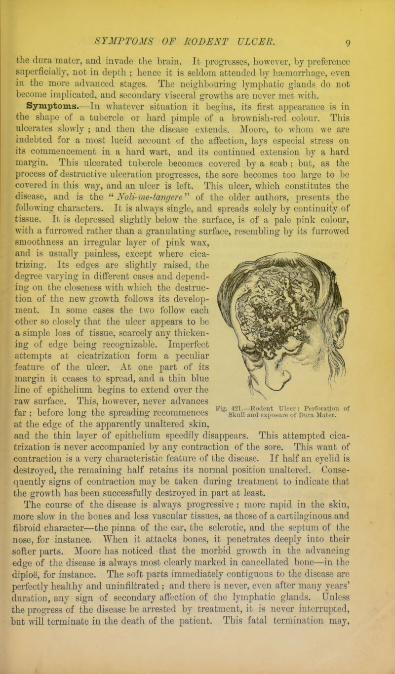 the dura mater, and invade the brain. It progresses, however, by preference superficially, not in depth ; hence it is seldom attended by haemorrhage, even iu the more advanced stages. The neighbouring lymphatic glands do not become implicated, and secondary visceral growths are never met with. Symptoms.—In whatever situation it begins, its first appearance is in the shape of a tubercle or hard pimple of a brownish-red colour. This ulcerates slowly ; and then the disease extends. Moore, to whom we are indebted for a most lucid account of the affection, lays especial stress on its commencement in a hard wart, and its continued extension by a hard margin. This ulcerated tubercle becomes covered by a scab ; but, as the process of destructive ulceration progresses, the sore becomes too large to be covered in this way, and an ulcer is left. This ulcer, which constitutes the disease, and is the  Noli-me-tangere of the older authors, presents the following characters. It is always single, and spreads solely by continuity of tissue. It is depressed slightly below the surface, is of a pale pink colour, with a furrowed rather than a granulating surface, resembling by its furrowed smoothness an irregular layer of pink wax, and is usually painless, except where cica- trizing. Its edges are slightly raised, the degree varying in different cases and depend- ing on the closeness with which the destruc- tion of the new growth follows its develop- ment. In some cases the two follow each other so closely that the ulcer appears to be a simple loss of tissue, scarcely any thicken- ing of edge being recognizable. Imperfect attempts at cicatrization form a peculiar feature of the ulcer. At one part of its margin it ceases to spread, and a thin blue line of epithelium begins to extend over the raw surface. This, however, never advances far ; before long the spreading recommences at the edge of the apparently unaltered skin, and the thin layer of epithelium speedily disappears. This attempted cica- trization is never accompanied by any contraction of the sore. This want of contraction is a very characteristic feature of the disease. If half an eyelid is destroyed, the remaining half retains its normal position unaltered. Conse- quently signs of contraction may be taken during treatment to indicate that the growth has been successfully destroyed in part at least. The course of the disease is always progressive ; more rapid in the skin, more slow in the bones and less vascular tissues, as those of a cartilaginous and fibroid character—the pinna of the ear, the sclerotic, and the septum of the nose, for instance. When it attacks bones, it penetrates deeply into their softer parts. Moore has noticed that the morbid growth in the advancing edge of the disease is always most clearly marked in cancellated bone—in the diploe, for instance. The soft parts immediately contiguous to the disease are perfectly healthy and uninfiltrated ; and there is never, even after many years' duration, any sign of secondary affection of the lymphatic glands. Unless the progress of the disease be arrested by treatment, it is never interrupted, but will terminate in the death of the patient. This fatal termination may, Fit 421 .—Rodent Ulcer : Perforation of .skull and exposure of Dura Mater.