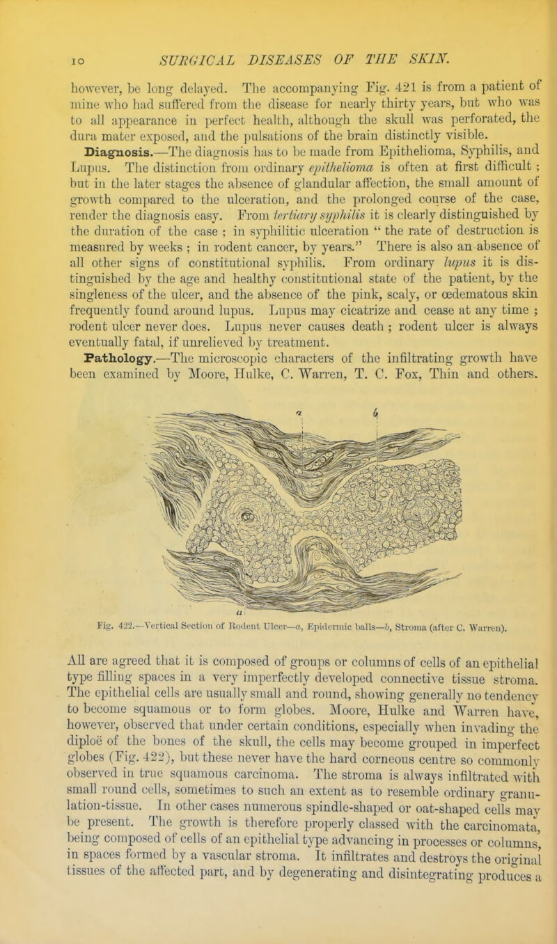 however, be long delayed. The accompanying Fig. 421 is from a patient of mine who had suffered from the disease for nearly thirty years, but who was to all appearance in perfect health, although the skull was perforated, the dura mater exposed, and the pulsations of the brain distinctly visible. Diagnosis.—The diagnosis has bo be made from Epithelioma, Syphilis, and Lupus. The distinction from ordinary epithelioma is often at first difficult ; but in the later stages the absence of glandular affection, the small amount of growth compared to the ulceration, and the prolonged course of the case, render the diagnosis easy. From tertiary syphilis it is clearly distinguished by the duration of the case ; in syphilitic ulceration  the rate of destruction is measured by weeks ; in rodent cancer, by years. There is also an absence of all other signs of constitutional syphilis. From ordinary lupus it is dis- tinguished by the age and healthy constitutional state of the patient, by the singleness of the ulcer, and the absence of the pink, scaly, or cedematous skin frequently found around lupus. Lupus may cicatrize and cease at any time ; rodent ulcer never does. Lupus never causes death ; rodent ulcer is always eventually fatal, if unrelieved by treatment. Pathology.—The microscopic characters of the infiltrating growth have been examined by Moore, Hulke, C. Warren, T. C. Fox, Thin and others. Fig. 422.—Vertical Section of Rodent Ulcer—a, Epidermic balls—!), Stroma (after C. Warren). All are agreed that it is composed of groups or columns of cells of an epithelial type filling spaces in a very imperfectly developed connective tissue stroma. The epithelial cells are usually small and round, showing generally notendencv to become squamous or to form globes. Moore, Hulke and Warren have, however, observed that under certain conditions, especially when invading the diploe of the bones of the skull, the cells may become grouped in imperfect globes (Fig. 422), but these never have the hard corneous centre so commonly observed in true squamous carcinoma. The stroma is always infiltrated with small round cells, sometimes to such an extent as to resemble ordinary granu- lation-tissue. In other cases numerous spindle-shaped or oat-shaped cells mav be present. The growth is therefore properly classed with the carcinomata, being composed of cells of an epithelial type advancing in processes or columns' in spaces formed by a vascular stroma. It infiltrates and destroys the original tissues of the affected part, and by degenerating and disintegrating produces a