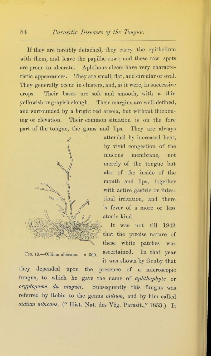 If they are forcibly detached, they carry the epithelium with them, and leave the papillae raw ; and these raw spots are prone to ulcerate. Aphthous ulcers have very characte- ristic appearances. They are small, flat, and circular or oval. They generally occur in clusters, and, as it were, in successive crops. Their bases are soft and smooth, with a thin yellowish or grayish slough. Their margins are well-defined, and surrounded by a bright red areola, but without thicken- ing or elevation. Their common situation is on the fore part of the tongue, the gums and lips. They are ahvays attended bv increased heat, by vivid congestion of the mucous membrane, not merely of the tongue but also of the inside of the mouth and lijas, together with active gastric or intes- tinal irritation, and there is fever of a more or less atonic kind. _ It was not till 1842 'W^^iT^^^^^^:^^ that the precise nature of these white patches was Fm. i9.-0idium albicans, x 300. ascertained. In that year it was shown by Gruby that they depended upon the presence of a microscopic fungus, to which he gave the name of aphthaphyte or cryptogams du muguet. Subsequently this fungus was referred by Robin to the genus oidium, and by him called oidium albicans. Hist. Nat. des Veg. Parasit./' 1853.) It