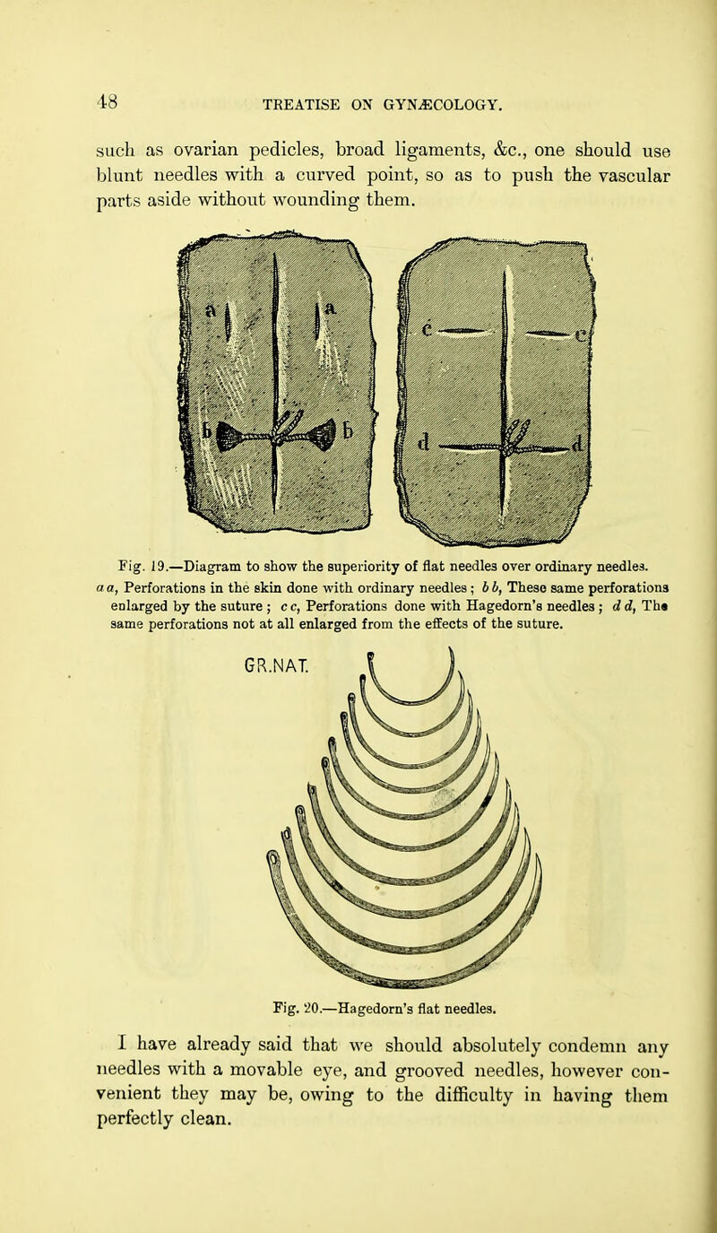 such as ovarian pedicles, broad ligaments, &c, one should use blunt needles with a curved point, so as to push the vascular parts aside without wounding them. Fig. 19.—Diagram to show the superiority of flat needle3 over ordinary needles. a a, Perforations in the skin done with ordinary needles; b b, These same perforations enlarged by the suture ; c c, Perforations done with Hagedorn's needles ; d d, Th« same perforations not at all enlarged from the effects of the suture. Fig. '20.—Hagedorn's flat needles. I have already said that we should absolutely condemn any needles with a movable eye, and grooved needles, however con- venient they may be, owing to the difficulty in having them perfectly clean.