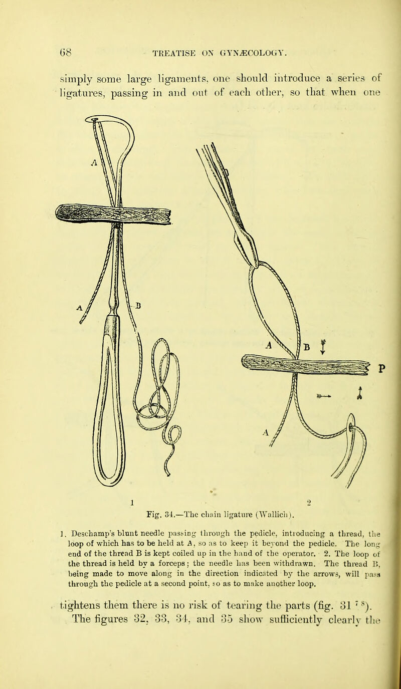 simply some large ligaments, one should introduce a series of ligatures, passing in and out of each other, so that when one l 2 Fig. 31.—The chain ligature (Wallich ). 1. Deschamp's blunt needle passing through the pedicle, intioducing a thread, the loop of which has to be held at A, so as to keep it beyond the pedicle. The long end of the thread B is kept coiled up in the hand of the operator. 2. The loop of the thread is held by a forceps; the needle has been withdrawn. The thread 1>, being made to move along in the direction indicated by the arrows, will pass through the pedicle at a second point, so as to make another loop. tightens them there is no risk of tearing the parts (fig. ol 7 s). The figures 32, 33, 34, and 35 show sufficiently clearh the