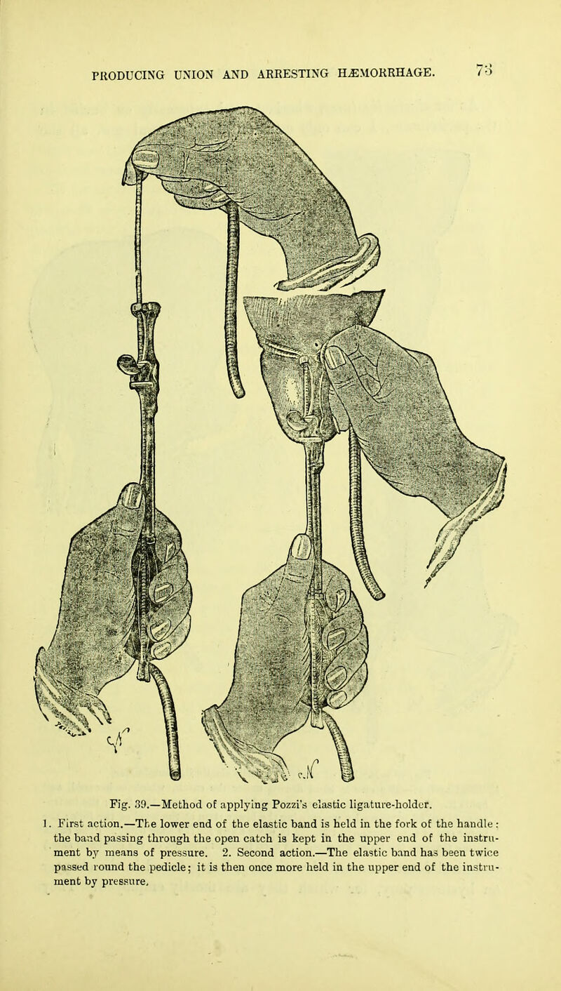 Fig. 39.—Method of applying Pozzi's elastic ligature-holder. 1. First action.—The lower end of the elastic band is held in the fork of the handle : the band passing through the open catch is kept in the upper end of the instru- ment by means of pressure. 2. Second action.—The elastic band has been twice passed round the pedicle; it is then once more held in the upper end of the instru- ment by pressure.