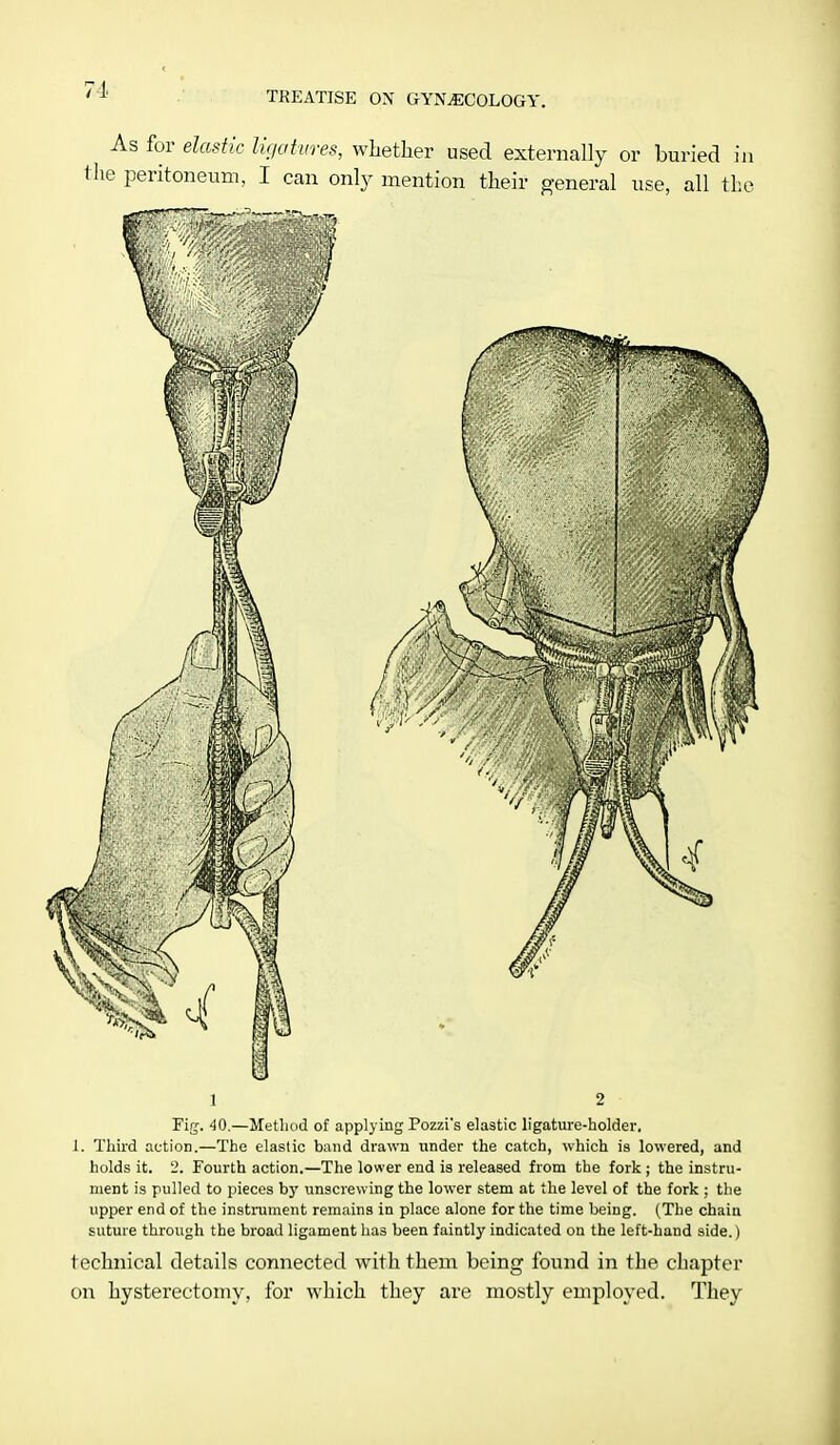 1 2 Fig. 40.—Method of applying Pozzi*s elastic ligature-holder. J. Third action.—The elastic band drawn under the catch, which is lowered, and holds it. 2. Fourth action.—The lower end is released from the fork; the instru- ment is pulled to pieces by unscrewing the lower stem at the level of the fork ; the upper end of the instrument remains in place alone for the time being. (The chain suture through the broad ligament has been faintly indicated on the left-hand side.) technical details connected with them being found in the chapter on hysterectomy, for which they are mostly employed. They