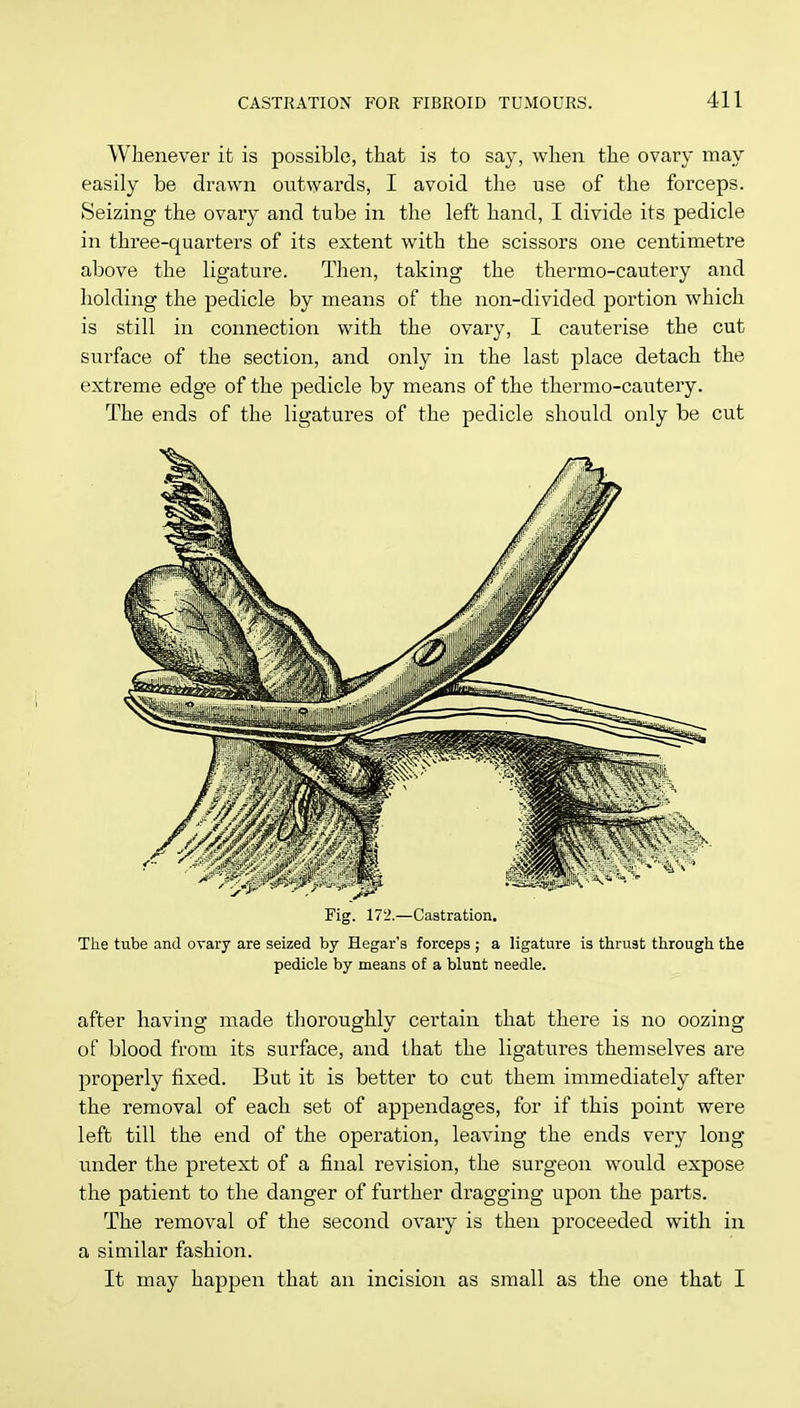 Whenever it is possible, that is to say, when the ovary may easily be drawn outwards, I avoid the use of the forceps. Seizing the ovary and tube in the left hand, I divide its pedicle in three-quarters of its extent with the scissors one centimetre above the ligature. Then, taking the thermo-cautery and holding the pedicle by means of the non-divided portion which is still in connection with the ovary, I cauterise the cut surface of the section, and only in the last place detach the extreme edge of the pedicle by means of the thermo-cautery. The ends of the ligatures of the pedicle should only be cut Fig. 172.—Castration. The tube and ovary are seized by Hegar's forceps ; a ligature is thrust through the pedicle by means of a blunt needle. after having made thoroughly certain that there is no oozing of blood from its surface, and that the ligatures themselves are properly fixed. But it is better to cut them immediately after the removal of each set of appendages, for if this point were left till the end of the operation, leaving the ends very long under the pretext of a final revision, the surgeon would expose the patient to the danger of further dragging upon the parts. The removal of the second ovary is then proceeded with in a similar fashion. It may happen that an incision as small as the one that I