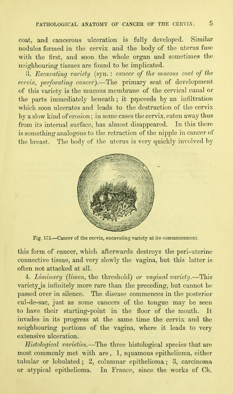 coat, and cancerous ulceration is fully developed. Similar nodules formed in the cervix and the body of the uterus fuse with the first, and soon the whole organ and sometimes the neighbouring tissues are found to be implicated. 3. Excavating variety (syn. : cancer of the mucous coat of the cervix, perforating cancer).—The primary seat of development of this variety is the mucous membrane of the cervical canal or the parts immediately beneath; it proceeds by an infiltration which soon ulcerates and leads to the destruction of the cervix by a slow kind of erosion; in some cases the cervix, eaten away thus from its internal surface, has almost disappeared. In this there is something analogous to the retraction of the nipple in cancer of the breast. The body of the uterus is very quickly involved by Fig. 175.—Cancer of the cervix, excavating variety at its commencement. this form of cancer, which afterwards destroys the peri-uterine connective tissue, and very slowly the vagina, but this latter is often not attacked at all. 4. Liminary (limen, the threshold) or vaginal variety.—This varietyjs infinitely more rare than the preceding, but cannot be passed over in silence. The disease commences in the posterior cul-de-sac, just as some cancers of the tongue may be seen to have their starting-point in the floor of the mouth. It invades in its progress at the same time the cervix and the neighbouring portions of the vagina, where it leads to very extensive ulceration. Histological varieties.—The three histological species that are most commonly met with are, 1, squamous epithelioma, either tubular or lobulated ; 2, columnar epithelioma ; 3, carcinoma or atypical epithelioma. In France, since the works of Ch.