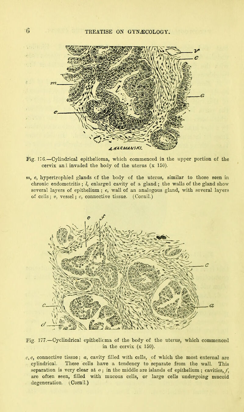 G Fig. I7G.—Cylindrical epithelioma, which commenced in the upper portion of the cervix anl invaded the body of the uterus (x 150). m, e, hypertrophied glands cf the body of the uterus, similar to those seen in chronic endometritis ; I, enlarged cavity of a gland; the walls of the gland show several layers of epithelium ; e, wall of an analogous gland, with several layers of cells; v, vessel; c, connective tissue. (Cornil.) Fig. 177.—Cyclindrical epithelicma of the body of the uterus, which commenced in the cervix (x 150). c, c, connective tissue; a, cavity rilled with cells, of which the most external are cylindrical. These cells have a tendency to separate from the wall. This separation is very clear at o; in the middle are islands of epithelium ; cavities, /', are often seen, filled with mucous cells, or large cells undergoing mucoid degeneration. (.Comil.)