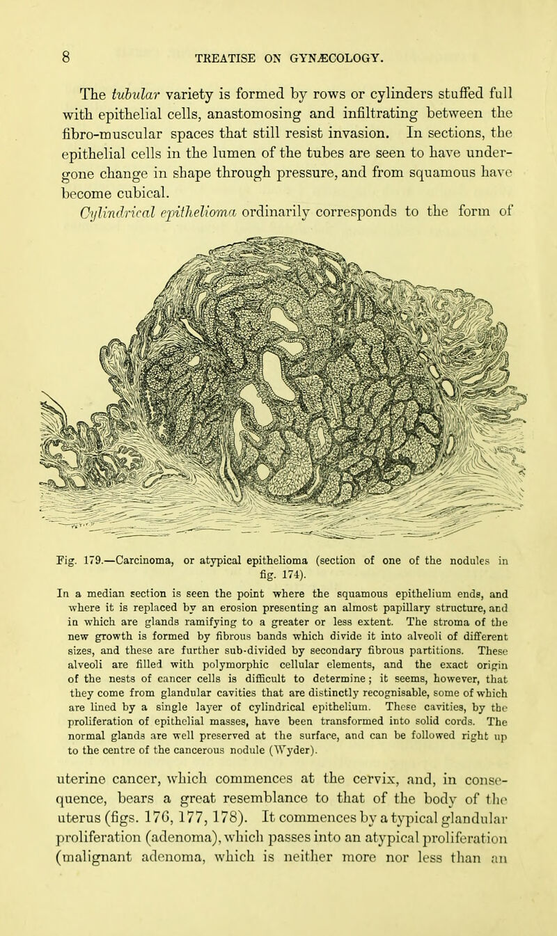 The tubular variety is formed by rows or cylinders stuffed full with epithelial cells, anastomosing and infiltrating between the fibro-nmscular spaces that still resist invasion. In sections, the epithelial cells in the lumen of the tubes are seen to have under- gone change in shape through pressure, and from squamous have become cubical. Cylindrical epithelioma ordinarily corresponds to the form of Fig. 179.—Carcinoma, or atypical epithelioma (section of one of the nodules in fig. 174). In a median section is seen the point where the squamous epithelium ends, and where it is replaced by an erosion presenting an almost papillary structure, and in which are glands ramifying to a greater or less extent. The stroma of the new growth is formed by fibrous bands which divide it into alveoli of different sizes, and these are further sub-divided by secondary fibrous partitions. These alveoli are filled with polymorphic cellular elements, and the exact origin of the nests of cancer cells is difficult to determine ; it seems, however, that they come from glandular cavities that are distinctly recognisable, some of which are lined by a single layer of cylindrical epithelium. These cavities, by the proliferation of epithelial masses, have been transformed into solid cords. The normal glands are well preserved at the surface, and can be followed right up to the centre of the cancerous nodule (Wyder). uterine cancer, which commences at the cervix, and, in conse- quence, bears a great resemblance to that of the body of the uterus (figs. 17G, 177,178). It commences by a typical glandular proliferation (adenoma), which passes into an atypical proliferation (malignant adenoma, which is neither more nor less than an