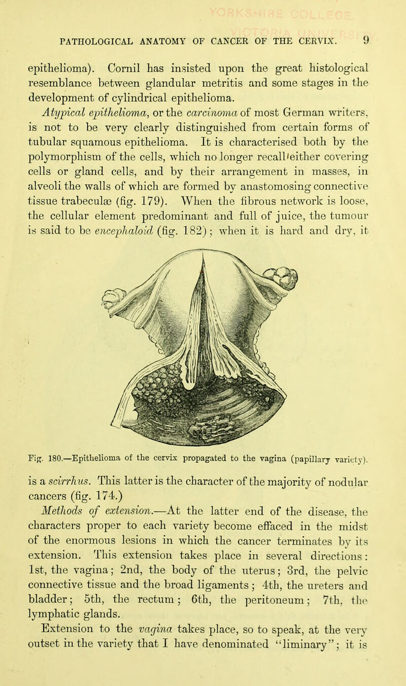 epithelioma). Cornil has insisted upon the great histological resemblance between glandular metritis and some stages in the development of cylindrical epithelioma. Atypical epithelioma, or the carcinoma of most German writers, is not to be very clearly distinguished from certain forms of tubular squamous epithelioma. It is characterised both by the polymorphism of the cells, which no longer recall'either covering cells or gland cells, and by their arrangement in masses, in alveoli the walls of which are formed by anastomosing connective tissue trabecular (fig. 179). When the fibrous network is loose, the cellular element predominant and full of juice, the tumour is said to be encephaloid (fig. 182); when it is hard and dry, it Fig. 180.—Epithelioma of the cervix propagated to the vagina (papillary variety). is a scirrhus. This latter is the character of the majority of nodular cancers (fig. 174.) Methods of extension.—At the latter end of the disease, the characters proper to each variety become effaced in the midst of the enormous lesions in which the cancer terminates by its extension. This extension takes place in several directions: 1st, the vagina; 2nd, the body of the uterus; 3rd, the pelvic connective tissue and the broad ligaments ; 4th, the ureters and bladder; 5th, the rectum; 6th, the peritoneum; 7th, the lymphatic glands. Extension to the vagina takes place, so to speak, at the very outset in the variety that I have denominated liminary; it is