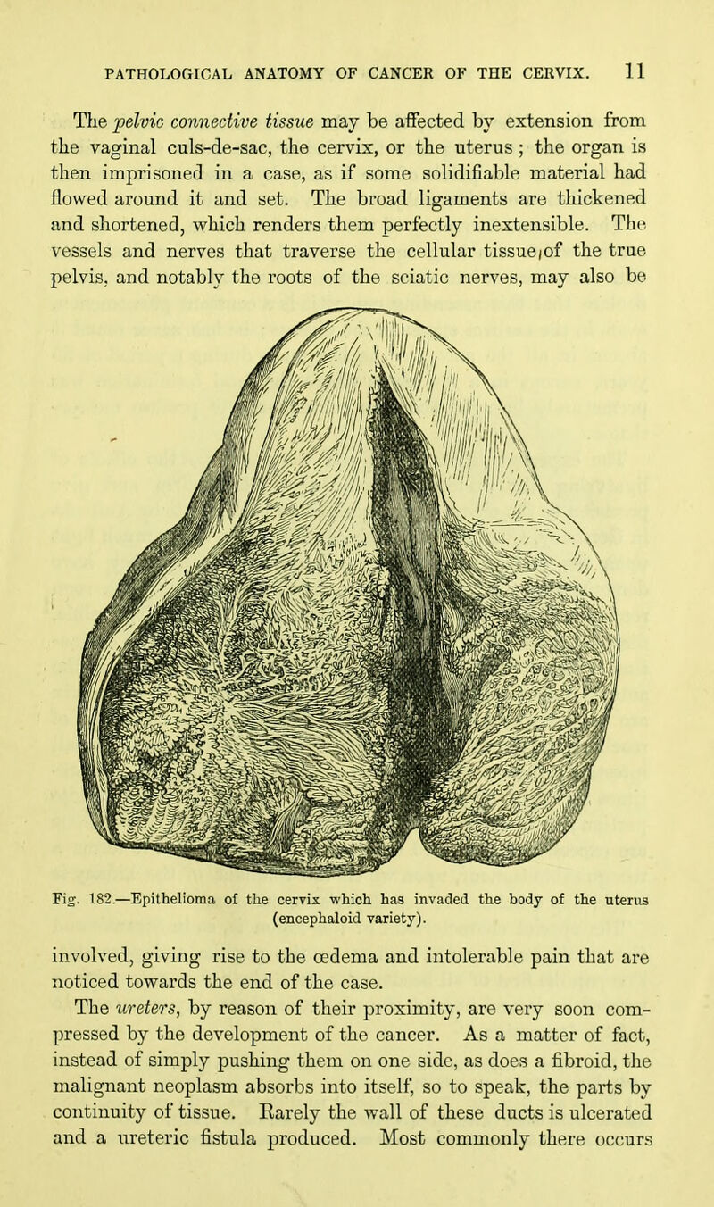 The pelvic connective tissue may be affected by extension from the vaginal culs-de-sac, the cervix, or the uterus ; the organ is then imprisoned in a case, as if some solidifiable material had flowed around it and set. The broad ligaments are thickened and shortened, which renders them perfectly inextensible. The vessels and nerves that traverse the cellular tissue / of the true pelvis, and notably the roots of the sciatic nerves, may also be Fig. 182.—Epithelioma of the cervix which has invaded the body of the uterus (encephaloid variety). involved, giving rise to the oedema and intolerable pain that are noticed towards the end of the case. The ureters, by reason of their proximity, are very soon com- pressed by the development of the cancer. As a matter of fact, instead of simply pushing them on one side, as does a fibroid, the malignant neoplasm absorbs into itself, so to speak, the parts by continuity of tissue. Rarely the wall of these ducts is ulcerated and a ureteric fistula produced. Most commonly there occurs