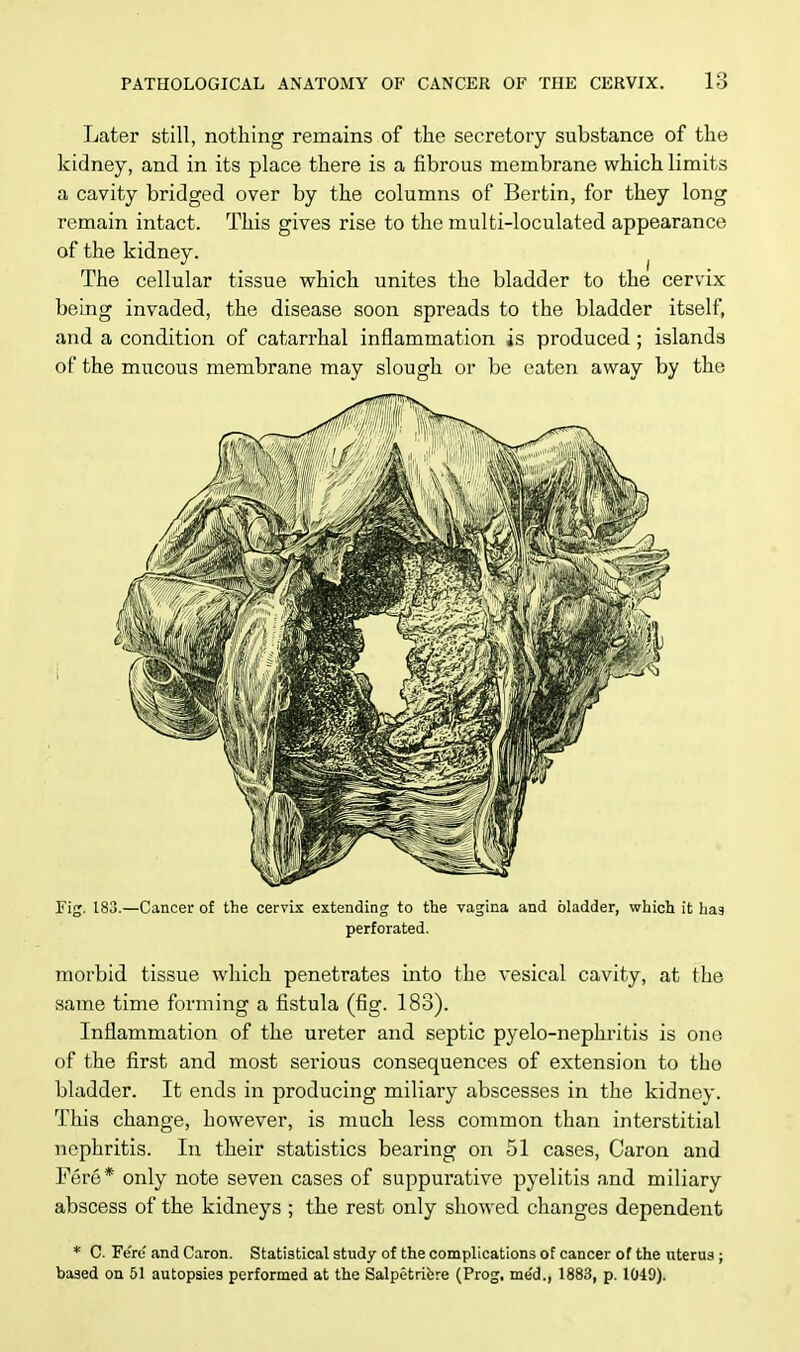 Later still, nothing remains of the secretory substance of the kidney, and in its place there is a fibrous membrane which limits a cavity bridged over by the columns of Bertin, for they long remain intact. This gives rise to the multi-loculated appearance of the kidney. The cellular tissue which unites the bladder to the cervix being invaded, the disease soon spreads to the bladder itself, and a condition of catarrhal inflammation is produced ; islands of the mucous membrane may slough or be eaten away by the Fig. 183.—Cancer of the cervix extending to the vagina and bladder, which it has perforated. morbid tissue which penetrates into the vesical cavity, at the same time forming a fistula (fig. 183). Inflammation of the ureter and septic pyelo-nephritis is one of the first and most serious consequences of extension to tho bladder. It ends in producing miliary abscesses in the kidney. This change, however, is much less common than interstitial nephritis. In their statistics bearing on 51 cases, Caron and Fere* only note seven cases of suppurative pyelitis and miliary abscess of the kidneys ; the rest only showed changes dependent * C. Fe're and Caron. Statistical study of the complications of cancer of the uterus ; based on 51 autopsies performed at the Salpetricre (Prog, me'd., 1883, p. 1049).