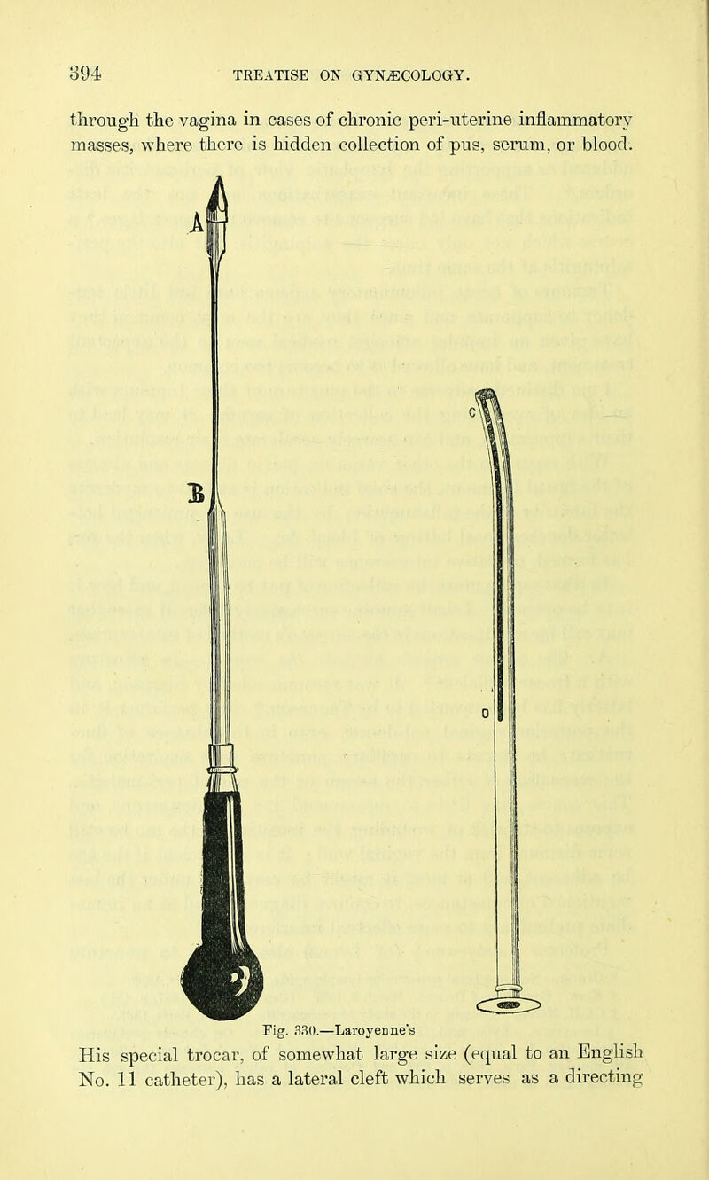 through the vagina in cases of chronic peri-uterine inflammatory masses, where there is hidden collection of pus, serum, or blood. Fig. 330.—Laroyenne's His special trocar, of somewhat large size (equal to an English No. 11 catheter), has a lateral cleft which serves as a directing