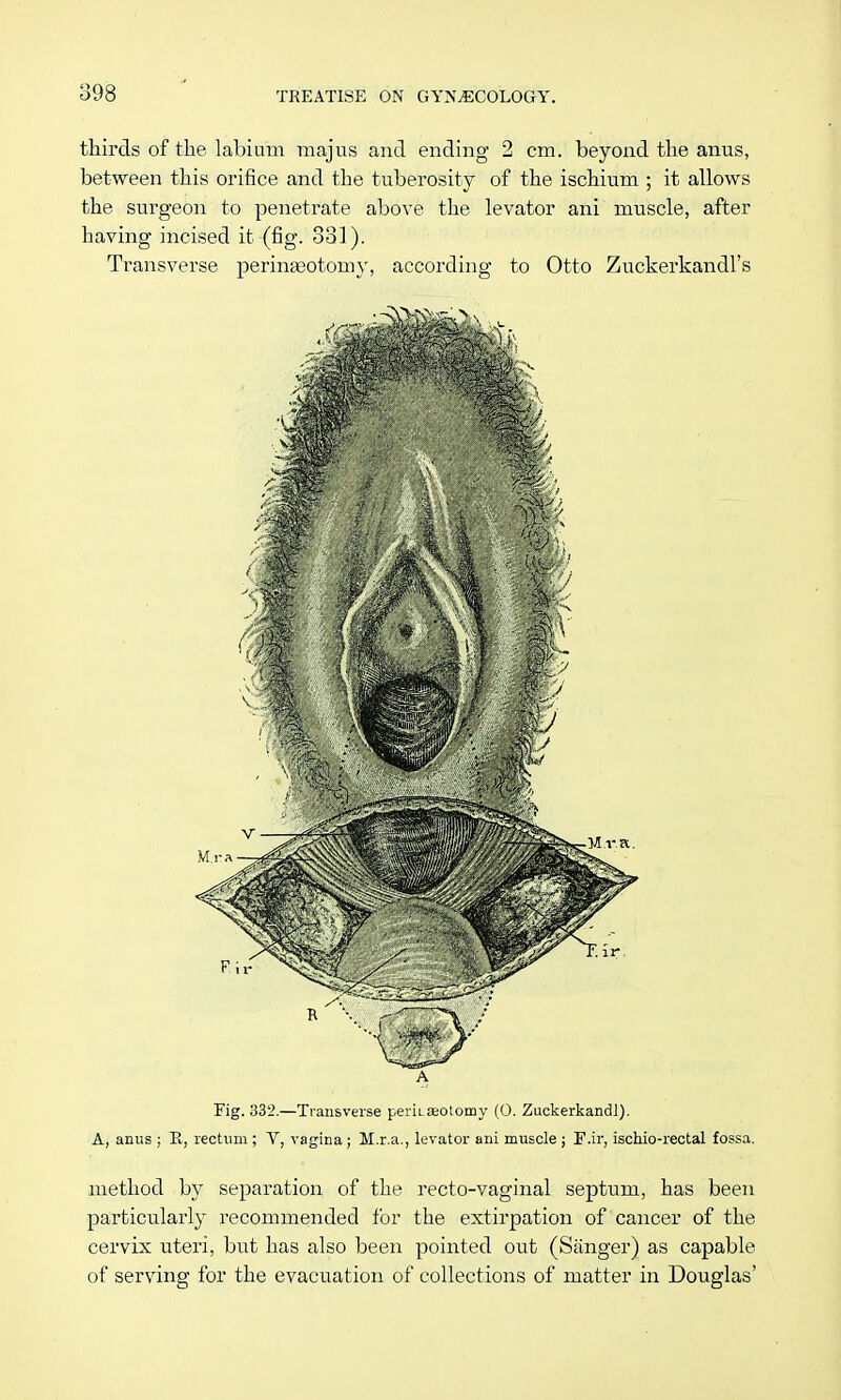 thirds of the labium majus and ending 2 cm. beyond the anus, between this orifice and the tuberosity of the ischium ; it allows the surgeon to penetrate above the levator ani muscle, after having incised it (fig. 331). Transverse perineotomy, according to Otto Zuckerkandl's A Fig. 332.—Transverse peruaeotomy (0. Zuckerkandl). A, anus ; R, rectum ; V, vagina; M.r.a., levator ani muscle ; F.ir, ischio-rectal fossa. method by separation of the recto-vaginal septum, has been particularly recommended for the extirpation of cancer of the cervix uteri, but has also been pointed out (Sanger) as capable of serving for the evacuation of collections of matter in Douglas'