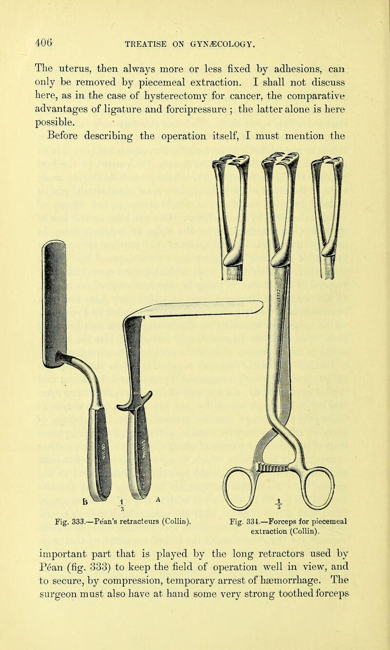 The uterus, then always more or less fixed by adhesions, can. only be removed by piecemeal extraction. I shall not discuss here, as in the case of hysterectomy for cancer, the comparative advantages of ligature and forcipressure ; the latter alone is here possible. Before describing the operation itself, I must mention the Fig. 333.—Pe'an's retract eurs (Collin). Fig. 331.—Forceps for piecemeal extraction (Collin). important part that is played by the long retractors used by Pean (fig. 338) to keep the field of operation well in view, and to secure, by compression, temporary arrest of haemorrhage. The surgeon must also have at hand some very strong toothed forceps