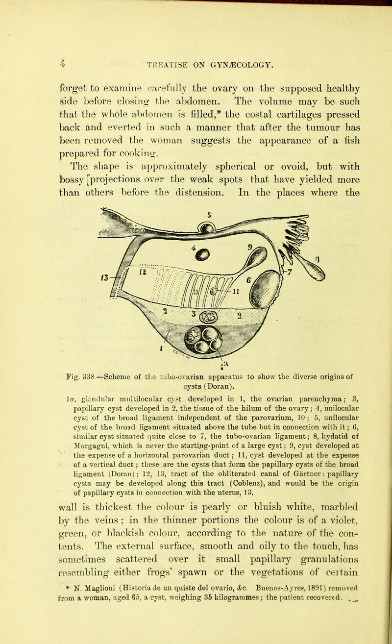 forget to examine carefully the ovary on the supposed healthy side before closing the abdomen. The volume may be such that the whole abdomen is filled,* the costal cartilages pressed back and everted in such a manner that after the tumour has been removed the woman suggests the appearance of a fish prepared for cooking. The shape is approximately spherical or ovoid, but with bossy [projections over the weak spots that have yielded more than others before the distension. In the places where the Fig. 338.—Scheme of the tubo-ovarian apparatus to show the diverse origins of cysts (Doran). In, glcndular multilocular cyst developed in 1, the ovarian parenchyma; 3, papillary cyst developed in 2, the tissue of the hilum of the ovary; 4, unilocular cyst of the broad ligament independent of the parovarium, 10 : 5, unilocular cyst of the broad ligament situated above the tube but in connection with it; G, similar cyst situated quite close to 7, the tubo-ovarian ligament; 8, hydatid of Morgagni, which is never the starting-point of a large cyst; 9, cyst developed at the expense of a horizontal parovarian duct; 11, cyst developed at the expense of a vertical duct; these are the cysts that form the papillary cysts of the broad ligament (Doranl : 12, 13, tract of the obliterated canal of Gartner: papillary cysts may be developed along this tract (Coblenz), and would be the origin of papillary cysts in connection with the uterus, 13. wall is thickest the colour is pearly or bluish white, marbled by the veins ; in the thinner portions the colour is of a violet, green, or blackish colour, according to the nature of the con- tents. The external surface, smooth and oily to the touch, has sometimes scattered over it small papillary granulations resembling either frogs' spawn or the vegetations of certain * N. Maglioni (Historia de uu quiste del ovario, 4c. Buenos-Ayres, 1801) removed from a woman, aged 65, a cyst, weighing 35 kilogrammes; the patient recovertd.