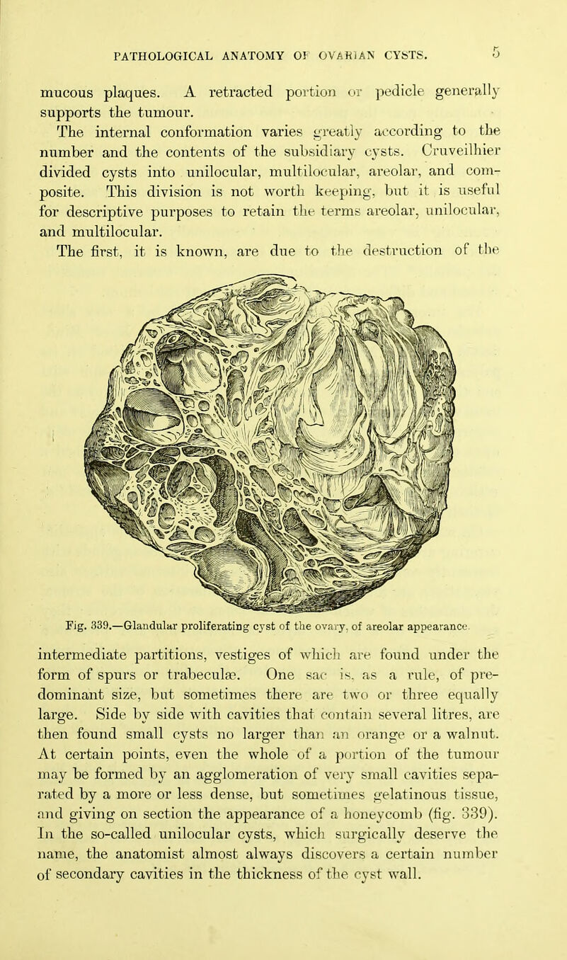 mucous plaques. A retracted portion or pedicle generally supports the tumour. The internal conformation varies greatly according to the number and the contents of the subsidiary cysts. Cruveilhier divided cysts into unilocular, multilocular, areolar, and com- posite. This division is not worth keeping, but it is useful for descriptive purposes to retain the terms areolar, unilocular, and multilocular. The first, it is known, are due to the destruction of the Fig. 339.—Glandular proliferating cyst of the ovary, of areolar appearance. intermediate partitions, vestiges of which are found under the form of spurs or trabecule?. One sac is. as a rule, of pre- dominant size, but sometimes there are two or three equally large. Side by side with cavities that contain several litres, are then found small cysts no larger than an orange or a walnut. At certain points, even the whole of a portion of the tumour may be formed by an agglomeration of very small cavities sepa- rated by a more or less dense, but sometimes gelatinous tissue, and giving on section the appearance of a honeycomb (fig. 339). In the so-called unilocular cysts, which surgically deserve the name, the anatomist almost always discovers a certain number of secondary cavities in the thickness of the cyst wall.