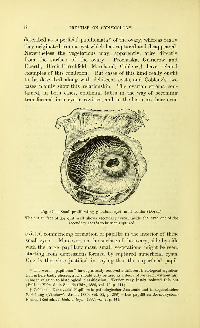 described as superficial papillomata * of the ovary, whereas really they originated from a cyst which has ruptured and disappeared. Nevertheless the vegetations may, apparently, arise directly from the surface of the ovary. Prochaska, Gusserow and Eberth, Birch-Hirschfeld, Marchand, Coblenz,t have related examples of this condition. But cases of this kind really ought to be described along with dehiscent cysts, and Coblenz's two cases plainly show this relationship. The ovarian stroma con- tained, in both cases, epithelial tubes in the way of becoming transformed into cystic cavities, and in the last case there even Fig. 340.—Small proliferating glandular cyst, multilocular (Doran). The cut surface of the cyst wall shows secondary cysts; inside the cyst one of the secondary sacs is to be seen ruptured. existed commencing formation of papillas in the interior of these small cysts. Moreover, on the surface of the ovary, side by side with the large papillary mass, small vegetations might be seen, starting from depressions formed by ruptured superficial cysts. One is therefore justified in saying that the superficial papil- * The word  papilloma having already received a different histological significa- tion is here badly chosen, and should only be used as a descriptive term, without any value in relation to histological classification. Terrier very justly pointed this out (Bull, et Me'm. de la Soc. de Chir., 1886, vol. 12, p. 411). t Coblenz. Das ovarial Papillom in pathologischer Anatomie und histogenetischer Beziehung (Virchow's Arch., 1880, vol. 82, p. 268).—Die papilliiren Adenokystom- formen (Zeitschr. f. Geb. u. Gyn., 1882, vol. 7, p. 14).