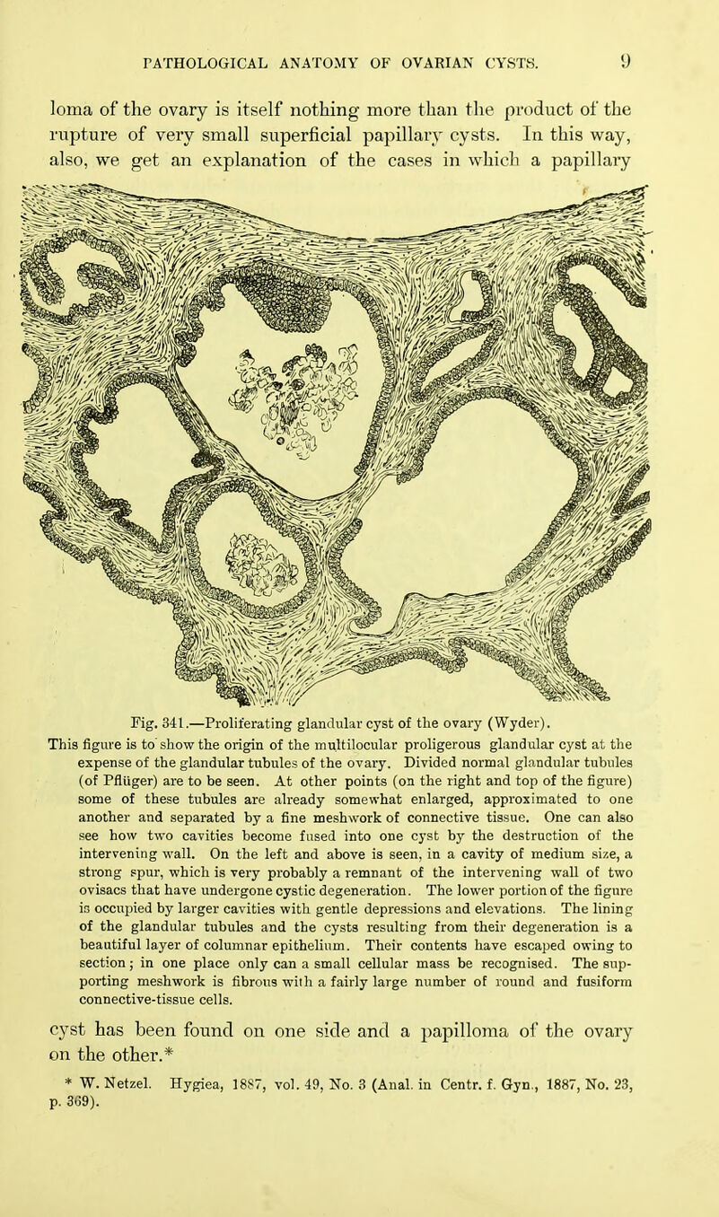 Ionia of the ovary is itself nothing more than the product of the rupture of very small superficial papillary cysts. In this way, also, we get an explanation of the cases in which a papillary Fig. 341.—Proliferating glandular cyst of the ovary (Wyder). This figure is to show the origin of the multilocular proligerous glandular cyst at the expense of the glandular tubules of the ovary. Divided normal glandular tubules (of Pfluger) are to be seen. At other points (on the right and top of the figure) some of these tubules are already somewhat enlarged, approximated to one another and separated by a fine meshwork of connective tissue. One can also see how two cavities become fused into one cyst by the destruction of the intervening wall. On the left and above is seen, in a cavity of medium size, a strong spur, which is very probably a remnant of the intervening wall of two ovisacs that have undergone cystic degeneration. The lower portion of the figure is occupied by larger cavities with gentle depressions and elevations. The lining of the glandular tubules and the cysts resulting from their degeneration is a beautiful layer of columnar epithelium. Their contents have escaped owing to section; in one place only can a small cellular mass be recognised. The sup- porting meshwork is fibrous with a fairly large number of round and fusiform connective-tissue cells. cyst has been found on one side and a papilloma of the ovary on the other.* * W. Netzel. Hygiea, 1887, vol. 49, No. 3 (Anal, in Centr. f. Gyn., 1887, No. 23, p. 3G9).