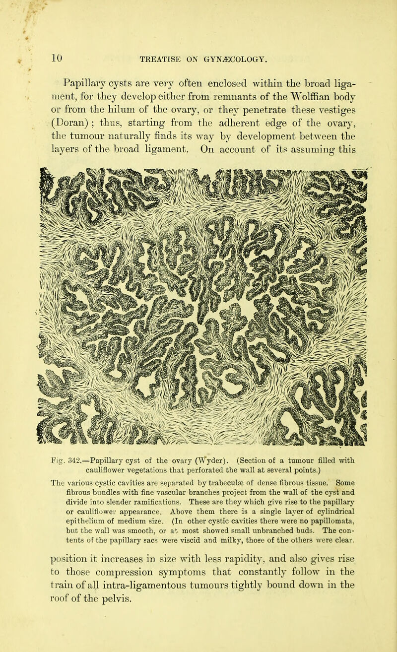 Papillary cysts are very often enclosed within the broad liga- ment, for they develop either from remnants of the Wolffian body or from the hilnm of the ovary, or they penetrate these vestiges (Doran) ; thus, starting from the adherent edge of the ovary, the tumour naturally finds its way by development between the layers of the broad ligament. On account of its assuming this Fig. 342.—Papillary cyst of the ovary (Wyder). (Section of a tumour filled with cauliflower vegetations that perforated the wall at several points.) The various cystic cavities are separated by trabecular of dense fibrous tissue. Some fibrous bundles with fine vascular branches project from the wall of the cyst and divide into slender ramifications. These are they which give rise to the papillary or cauliflower appearance. Above them there is a single layer of cylindrical epithelium of medium size. (In other cystic cavities there were no papillomata, but the wall was smooth, or at most showed small unbranched buds. The con- tents of the papillary sacs were viscid and milky, those of the others were clear. position it increases in size with less rapidity, and also gives rise to those compression symptoms that constantly follow in the train of a|l intra-ligamentous tumours tightly bound down in the roof of the pelvis.