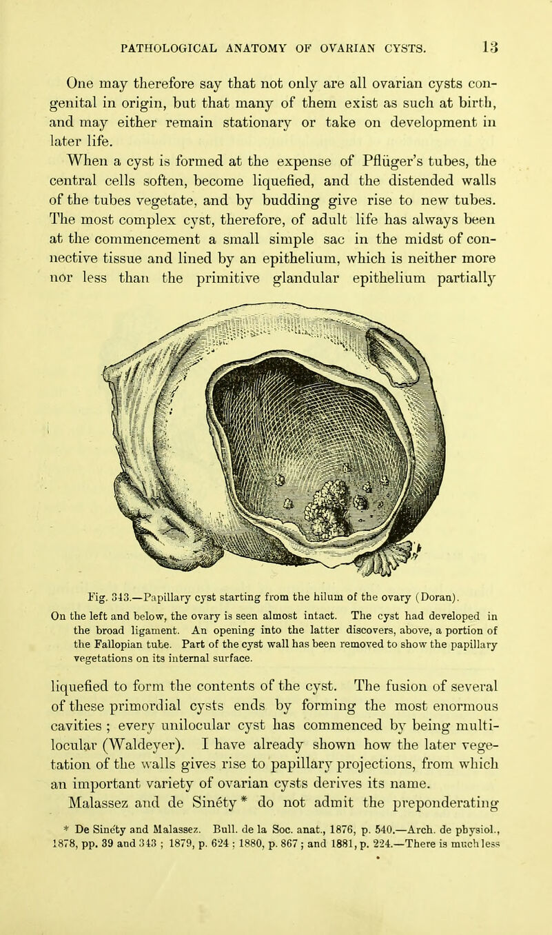 One may therefore say that not only are all ovarian cysts con- genital in origin, but that many of them exist as such at birth, and may either remain stationary or take on development in later life. When a cyst is formed at the expense of Pfliiger's tubes, the central cells soften, become liquefied, and the distended walls of the tubes vegetate, and by budding give rise to new tubes. The most complex cyst, therefore, of adult life has always been at the commencement a small simple sac in the midst of con- nective tissue and lined by an epithelium, which is neither more nor less than the primitive glandular epithelium partially Fig. 343.—Papillary cyst starting from the hiluui of the ovary (Doran). On the left and below, the ovary is seen almost intact. The cyst had developed in the broad ligament. An opening into the latter discovers, above, a portion of the Fallopian tube. Part of the cyst wall has been removed to show the papillary vegetations on its internal surface. liquefied to form the contents of the cyst. The fusion of several of these primordial cysts ends by forming the most enormous cavities ; every unilocular cyst has commenced by being multi- locular (Waldeyer). I have already shown how the later vege- tation of the walls gives rise to papillary projections, from which an important variety of ovarian cysts derives its name. Malassez and de Sinety* do not admit the preponderating * De Sinc'ty and Malassez. Bull, de la Soc. anat, 1876, p. 540.—Arch, de pbysiol., 1878, pp. 39 and 343 ; 1879, p. 624 : 1880, p. 867 ; and 1881, p. 224.—There is muchless