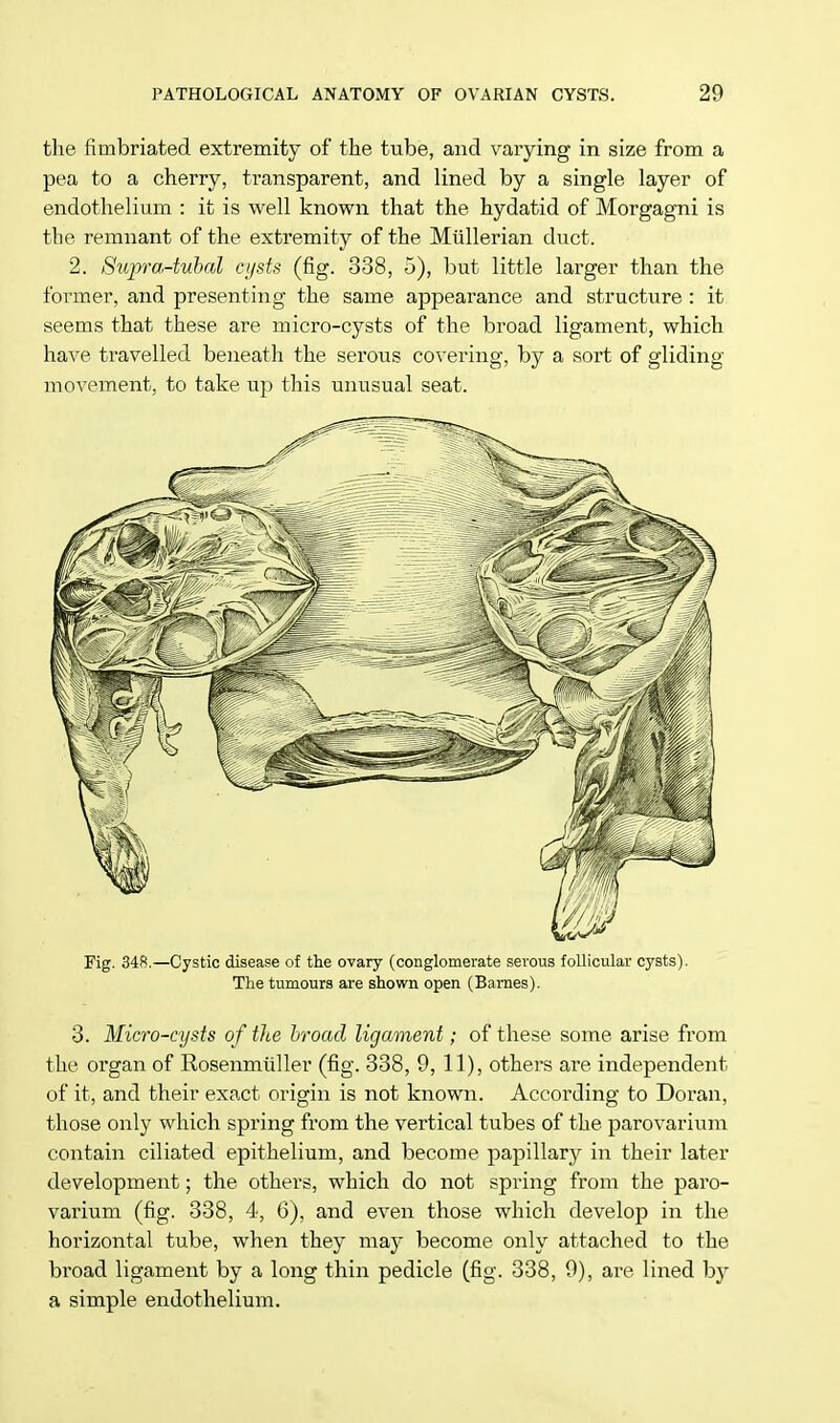 the fimbriated extremity of the tube, and varying in size from a pea to a cherry, transparent, and lined by a single layer of endothelium : it is well known that the hydatid of Morgagni is the remnant of the extremity of the Miillerian duct. 2. Siqrra-tubal cysts (fig. 338, 5), but little larger than the former, and presenting the same appearance and structure : it seems that these are micro-cysts of the broad ligament, which have travelled beneath the serous covering, by a sort of gliding movement, to take up this unusual seat. Fig. 348.—Cystic disease of the ovary (conglomerate serous follicular cysts). The tumours are shown open (Barnes). 3. Micro-cysts of the broad ligament; of these some arise from the organ of Rosenmiiller (fig. 338, 9, 11), others are independent of it, and their exact origin is not known. According to Doran, those only which spring from the vertical tubes of the parovarium contain ciliated epithelium, and become papillary in their later development; the others, which do not spring from the paro- varium (fig. 338, 4, 6), and even those which develop in the horizontal tube, when they may become only attached to the broad ligament by a long thin pedicle (fig. 338, 9), are lined by a simple endothelium.