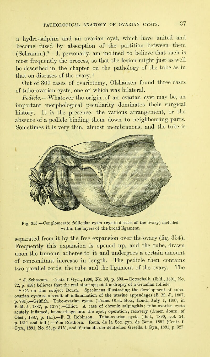 a hydrosalpinx and an ovarian cyst, which have united and become fused by absorption of the partition between thern (Schramm).* I, personally, am inclined to believe that such is most frequently the process, so that the lesion might just as well be described in the chapter on the pathology of the tube as in that on diseases of the ovary, f Out of 300 cases of ovariotomy, Olshausen found three cases of tubo-ovarian cysts, one of which was bilateral. Pedicle.—Whatever the origin of an ovarian cyst may be, an important morphological peculiarity dominates their surgical history. It is the presence, the various arrangement, or the absence of a pedicle binding them down to neighbouring parts. Sometimes it is very thin, almost membranous, and the tube is Fig. 355.—Conglomerate follicular cysts (cystic disease of the ovary) included within the layers of the broad ligament. separated from it by the free expansion over the ovary (fig. 354). Frequently this expansion is opened up, and the tube, drawn upon the tumour, adheres to it and undergoes a certain amount of concomitant increase in length. The pedicle then contains two parallel cords, the tube and the ligament of the ovary. The * J. Schramm. Centr. f. Gyn., 1890, No. 33, p. 593.—Gottschalk (ibid., 1891, No. 22, p. 458) believes that the real starting-point is dropsy of a Graafian follicle. t Cf. on this subject Doran. Specimens illustrating the development of tubo- ovarian cysts as a result of inflammation of the uterine appendages (B. H. J., 1887, p. 781).—Griffith. Tubo-ovarian cysts. (Trans. Obst. Soc, Lond., July 1, 1887, in B.M.J., 1887, p. 1277).—Elliot. A case of chronic salpingitis; tubo-ovarian cysts acutely inflamed, haemorrhage into the cyst; operation; recovery (Amer. Journ. of Obst., 1887, p. 141).—F. B. Robinson. Tubo-ovarian cysts (ibid., 1890, vol. 24, p. 1311 and foil.).—Von Rosthorn. Re'un. de la Soc. gyn. de Bonn, 1891 (Centr. f. Gyn., 1891, No. 25, p. 515), and Verhandl. der deutschen Gesells. f. Gyn., 1891, p. 327.