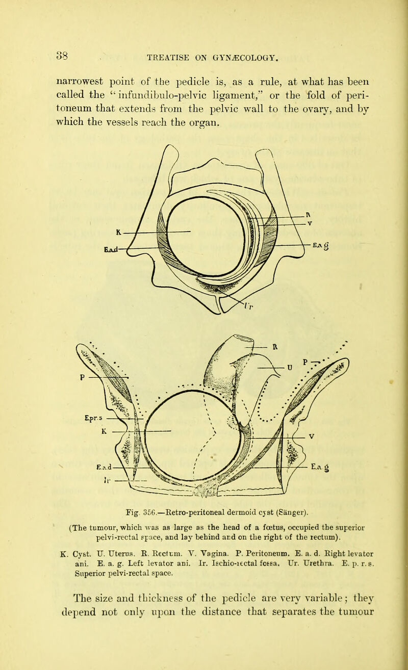 narrowest point of the pedicle is, as a rule, at what has been called the  infundibulo-pelvic ligament,7' or the fold of peri- toneum that extends from the pelvic wall to the ovary, and by which the vessels reach the organ. Fig 35G.—Retro-peritoneal dermoid cyst (Stinger). (The tumour, which was as large as the head of a foetus, occupied the superior pelvi-rectal space, and lay behind and on the right of the rectum). K. Cyst. TJ. Uterus. R. Recftm. V. Vagina. P. Peritoneum. E. a. d. Right levator ani. E. a. g. Left leTator ani. Ir. Ischio-uctal fossa. Ur. Urethra. E. p. r. s. Superior pelvi-rectal space. The size and tLickness of the pedicle are very variable; they depend not only upon the distance that separates the tumour
