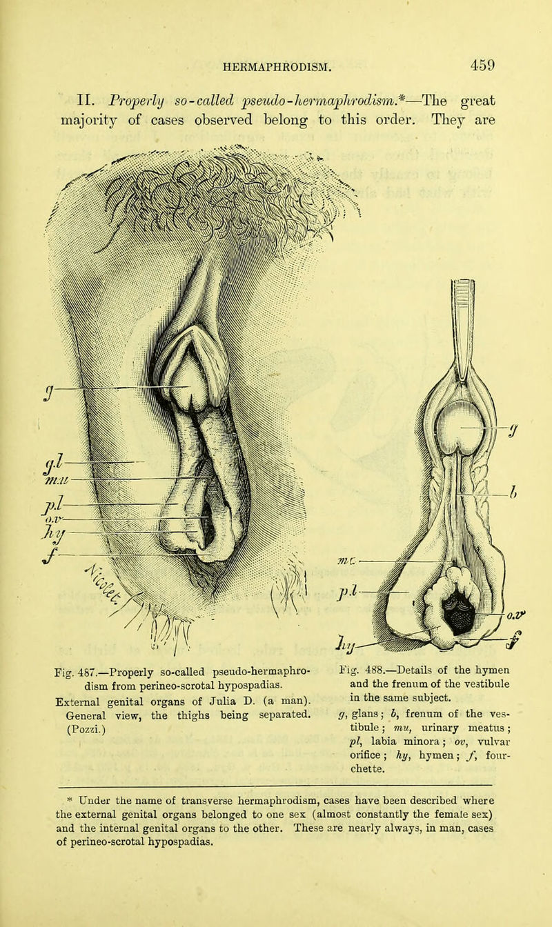 II. Properly so-called pseudo-Joermaphrodism*—The great majority of cases observed belong to this order. They are Fig. 487.—Properly so-called pseudo-hermaphro- dism from perineo-scrotal hypospadias. External genital organs of Julia D. (a man). General view, the thighs being separated. (Pozzi.) Pig. 488.—Details of the hymen and the frenum of the vestibule in the same subject. g, glans; b, frenum of the ves- tibule ; mu, urinary meatus; pi, labia minora; ov, vulvar orifice ; hy, hymen; f, fonr- chette. * Under the name of transverse hermaphrodism, cases have been described where the external genital organs belonged to one sex (almost constantly the female sex) and the internal genital organs to the other. These are nearly always, in man, cases of perineo-scrotal hypospadias.