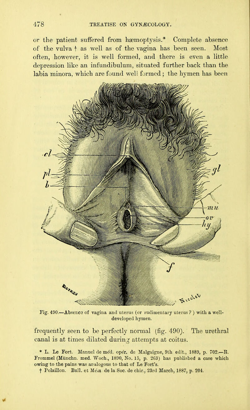 or the patient suffered from haemoptysis.* Complete absence of the vulva t as well as of the vagina has been seen. Most often, however, it is well formed, and there is even a little depression like an infundibulum, situated further back than the labia minora, which are found well formed; the hymen has been Pig. 490.—Absenca of vagina and uterus (or rudimentary uterus ? ) with a well- developed hymen. frequently seen to be perfectly normal (fig. 490). The urethral canal is at times dilated during attempts at coitus. * L. Le Fort. Manuel de mod. ope'r. de Malgaigne, 9th edit., 1889, p. 702.—II. Frommel (Munchn. med. Woch., 1890, No. 15, p. 2G3) has published a case which owing to the pains was analogous to that of Le Fort's. f Polaillon. Bull, et Mem de la Soc. de chir., 23rd March, 1887, p. 204.