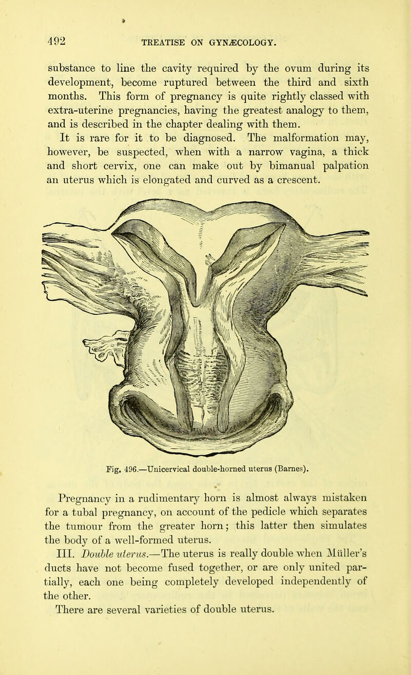 i substance to line the cavity required by the ovum during its development, become ruptured between the third and sixth months. This form of pregnancy is quite rightly classed with extra-uterine pregnancies, having the greatest analogy to them, and is described in the chapter dealing with them. It is rare for it to be diagnosed. The malformation may, however, be suspected, when with a narrow vagina, a thick and short cervix, one can make out by bimanual palpation an uterus which is elongated and curved as a crescent. Fig. 496.—Unicervical double-horned uterus (Barnes). Pregnancy in a rudimentary horn is almost always mistaken for a tubal pregnancy, on account of the pedicle which separates the tumour from the greater horn; this latter then simulates the body of a well-formed uterus. III. Double uterus.—The uterus is really double when Muller's ducts have not become fused together, or are only united par- tially, each one being completely developed independently of the other. There are several varieties of double uterus.