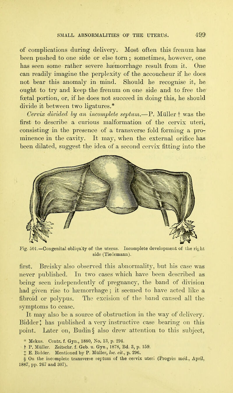 of complications during delivery. Most often this frenurn has been pushed to one side or else torn; sometimes, however, one has seen some rather severe haemorrhage result from it. One can readily imagine the perplexity of the accoucheur if he does not bear this anomaly in mind. Should he recognise it, he ought to try and keep the frenum on one side and to free the foetal portion, or, if he does not succeed in doing this, he should divide it between two ligatures.* Cervix divided by an incomplete septum.—P. Miiller t was the first to describe a curious malformation of the cervix uteri, consisting in the presence of a transverse fold forming a pro- minence in the cavity. It may, when the external orifice has been dilated, suggest the idea of a second cervix fitting into the Fig. 001.—Congenital obliquity of the uterus. Incomplete development of the right side (Tiedemann). first. Breisky also observed this abnormality, but his case was never published. In two cases which have been described as being seen independently of pregnancy, the band of division had given rise to haemorrhage ; it seemed to have acted like a fibroid or polypus. The excision of the band caused all the symptoms to cease. It may also be a source of obstruction in the way of delivery. Bidder J has published a very instructive case bearing on this point. Later on, Budin§ also drew attention to this subject, * Mekus. Centr. f. Gyn., 1880, No. 13, p. 294. t P. Miiller. Zeitschr. f. Geb. u. Gyn., 1878, Bd. 3, p. 159. X E. Bidder. Mentioned by P. Miiller, loc. cit., p. 296. § On the incomplete transverse septum of the cervix uteri (Progres me'd., April, 1887, pp. 267 and 307).