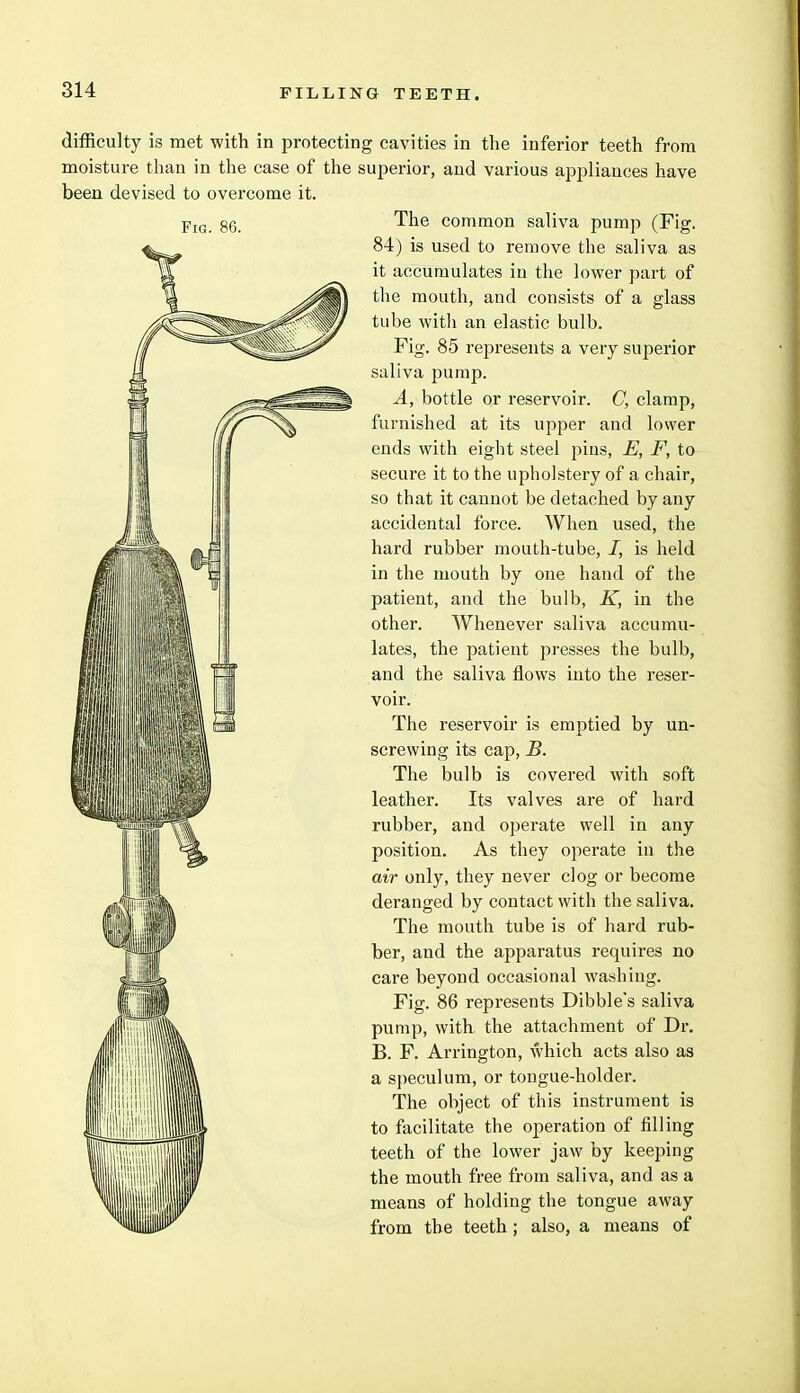 Fig. 86. difficulty is met with in protecting cavities in the inferior teeth from moisture than in the case of the superior, and various appliances have been devised to overcome it. The common saliva pump (Fig. 84) is used to remove the saliva as it accumulates in the lower part of the mouth, and consists of a glass tube with an elastic bulb. Fig. 85 represents a very superior saliva pump. A, bottle or reservoir. C, clamp, furnished at its upper and lower ends with eight steel pins, E, F, to secure it to the upholstery of a chair, so that it cannot be detached by any accidental force. When used, the hard rubber mouth-tube, i, is held in the mouth by one hand of the patient, and the bulb, K, in the other. Whenever saliva accumu- lates, the patient presses the bulb, and the saliva flows into the reser- voir. The reservoir is emptied by un- screwing its cap, B. The bulb is covered with soft leather. Its valves are of hard rubber, and operate well in any position. As they operate in the air only, they never clog or become deranged by contact with the saliva. The mouth tube is of hard rub- ber, and the apparatus requires no care beyond occasional washing. Fig. 86 represents Dibble's saliva pump, with the attachment of Dr. B. F. Arrington, which acts also as a speculum, or tongue-holder. The object of this instrument is to facilitate the operation of filling teeth of the lower jaw by keeping the mouth free from saliva, and as a means of holding the tongue away from the teeth ; also, a means of