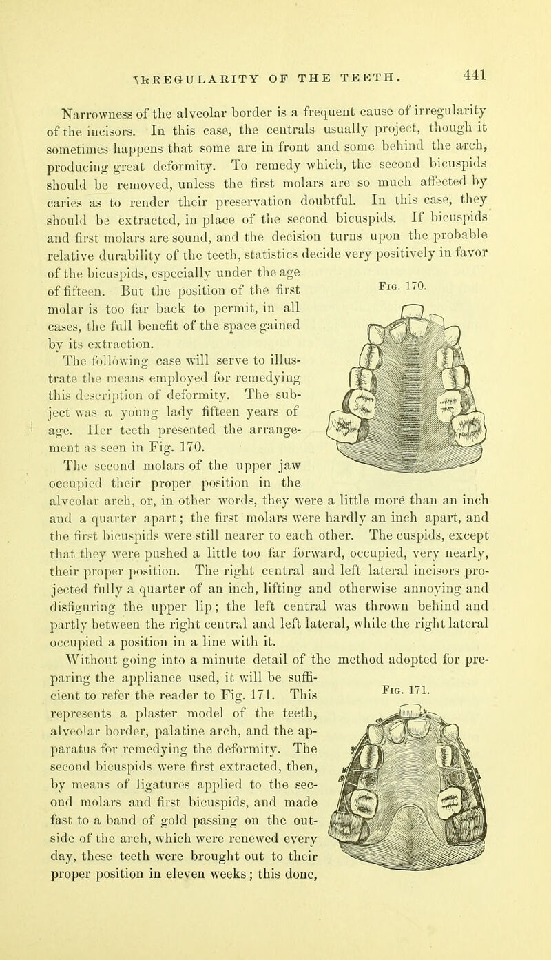 Narrowness of the alveolar border is a frequent cause of irregularity of the incisors. In this case, the centrals usually project, though it sometimes happens that some are in front and some behind the arch, producing great deformity. To remedy which, the second bicuspids should be removed, unless the first molars are so much affected by caries as to render their preservation doubtful. In this case, they should be extracted, in place of the second bicuspids. If bicuspids and first molars are sound, and the decision turns upon the probable relative durability of the teeth, statistics decide very positively in favor of the bicuspids, especially under the age of fifteen. But the position of the first molar is too far back to permit, in all cases, the full benefit of the space gained by its extraction. The following case will serve to illus- trate the means employed for remedying this description of deformity. The sub- ject was a young lady fifteen years of age. Her teeth presented the arrange- ment as seen in Fig. 170. The second molars of the upper jaw occupied their proper position in the alveolar arch, or, in other words, they were a little more than an inch and a quarter apart; the first molars were hardly an inch apart, and the first bicuspids were still nearer to each other. The cuspids, except that they were pushed a little too far forward, occupied, very nearly, their proper position. The right central and left lateral incisors pro- jected fully a quarter of an inch, lifting and otherwise annoying and disfiguring the upper lip; the left central was thrown behind and partly between the right central and left lateral, while the right lateral occupied a position in a line with it. Without going into a minute detail of the method adopted for pre- paring the appliance used, it will be suffi- cient to refer the reader to Fig. 171. This represents a plaster model of the teeth, alveolar border, palatine arch, and the ap- paratus for remedying the deformity. The second bicuspids were first extracted, then, by means of ligatures applied to the sec- ond molars and first bicuspids, and made fast to a band of gold passing on the out- side of the arch, which were renewed every day, these teeth were brought out to their proper position in eleven weeks; this done,