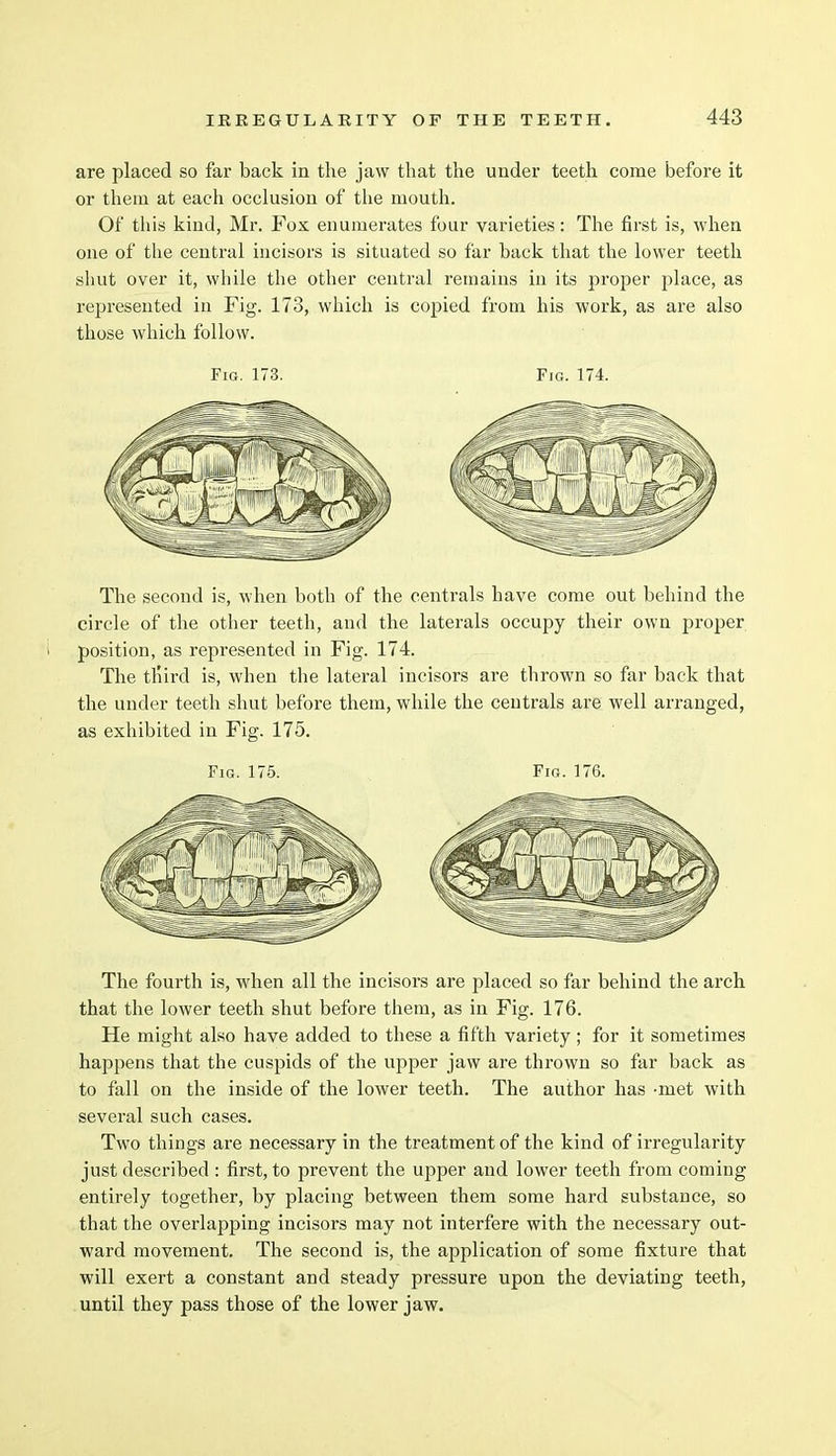 are placed so far back in the jaw that the under teeth come before it or them at each occlusion of the mouth. Of this kind, Mr. Fox enumerates four varieties: The first is, when one of the central incisors is situated so far back that the lower teeth shut over it, while the other central remains in its proper place, as represented in Fig. 173, which is copied from his work, as are also those which follow. Fig. 173. Fig. 174. The second is, when both of the centrals have come out behind the circle of the other teeth, and the laterals occupy their own proper position, as represented in Fig. 174. The third is, when the lateral incisors are thrown so far back that the under teeth shut before them, while the centrals are well arranged, as exhibited in Fig. 175. Fig. 175. Fig. 176. The fourth is, when all the incisors are placed so far behind the arch that the lower teeth shut before them, as in Fig. 176. He might also have added to these a fifth variety; for it sometimes happens that the cuspids of the upper jaw are thrown so far back as to fall on the inside of the lower teeth. The author has -met with several such cases. Two things are necessary in the treatment of the kind of irregularity just described : first, to prevent the upper and lower teeth from coming entirely together, by placing between them some hard substance, so that the overlapping incisors may not interfere with the necessary out- ward movement. The second is, the application of some fixture that will exert a constant and steady pressure upon the deviating teeth, until they pass those of the lower jaw.