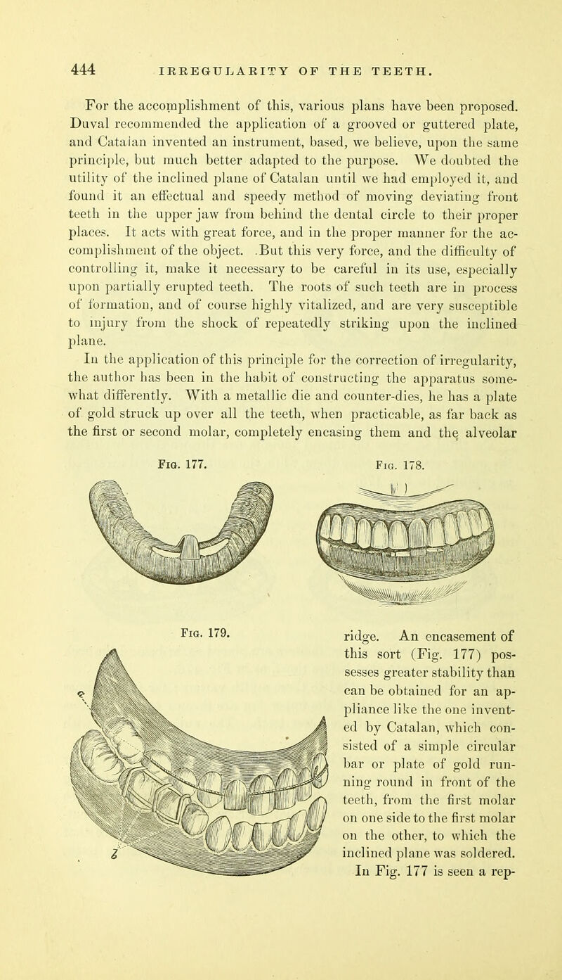 For the accomplishment of this, various plans have been proposed. Duval recommended the application of a grooved or guttered plate, and Catalan invented an instrument, based, we believe, upon the same principle, but much better adapted to the purpose. We doubted the utility of the inclined plane of Catalan until we had employed it, and found it an effectual and speedy method of moving deviating front teeth in the upper jaw from behind the dental circle to their proper places. It acts with great force, and in the proper manner for the ac- complishment of the object. .But this very force, and the difficulty of controlling it, make it necessary to be careful in its use, especially upon partially erupted teeth. The roots of such teeth are in process of formation, and of course highly vitalized, and are very susceptible to injury from the shock of repeatedly striking upon the inclined plane. In the application of this principle for the correction of irregularity, the author has been in the habit of constructing the apparatus some- what differently. With a metallic die and counter-dies, he has a plate of gold struck up over all the teeth, when practicable, as far back as the first or second molar, completely encasing them and the alveolar Fig. 177. Fig. 178. Fig. 179. ridge. An encasement of this sort (Fig. 177) pos- sesses greater stability than can be obtained for an ap- pliance like the one invent- ed by Catalan, which con- sisted of a simple circular bar or plate of gold run- ning round in front of the teeth, from the first molar on one side to the first molar on the other, to which the inclined plane was soldered. In Fig. 177 is seen a rep-