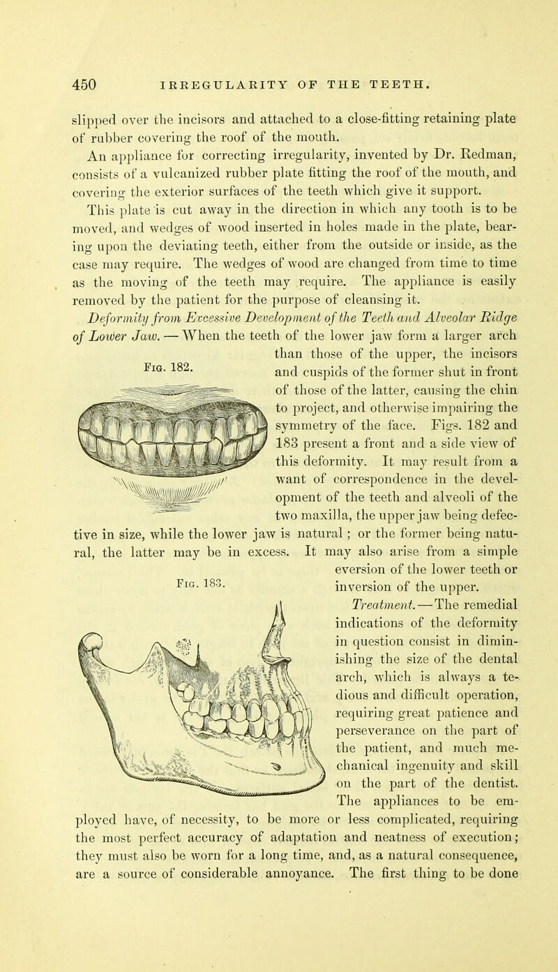 Fig. 182. slipped over the incisors and attached to a close-fitting retaining plate of rubber covering the roof of the mouth. An appliance for correcting irregularity, invented by Dr. Redman, consists of a vulcanized rubber plate fitting the roof of the mouth, and covering the exterior surfaces of the teeth which give it support. This plate is cut away in the direction in which any tooth is to be moved, and wedges of wood inserted in holes made in the plate, bear- ing upon the deviating teeth, either from the outside or inside, as the case may require. The wedges of wood are changed from time to time as the moving of the teeth may require. The appliance is easily removed by the patient for the purpose of cleansing it. Deformity from Excessive Development of the Teeth and Alveolar Ridge of Lower Jaw. — When the teeth of the lower jaw form a larger arch than those of the upper, the incisors and cuspids of the former shut in front of those of the latter, causing the chin to project, and otherwise impairing the symmetry of the face. Figs. 182 and 183 present a front and a side view of this deformity. It may result from a want of correspondence in the devel- opment of the teeth and alveoli of the two maxilla, the upper jaw being defec- tive in size, while the lower jaw is natural ; or the former being natu- ral, the latter may be in excess. It may also arise from a simple eversion of the lower teeth or inversion of the upper. Treatment.—The remedial indications of the deformity in question consist in dimin- ishing the size of the dental arch, which is always a te- dious and difficult operation, requiring great patience and perseverance on the part of the patient, and much me- chanical ingenuity and skill on the part of the dentist. The appliances to be em- ployed have, of necessity, to be more or less complicated, requiring the most perfect accuracy of adaptation and neatness of execution; they must also be worn for a long time, and, as a natural consequence, are a source of considerable annoyance. The first thing to be done Fig. 183.