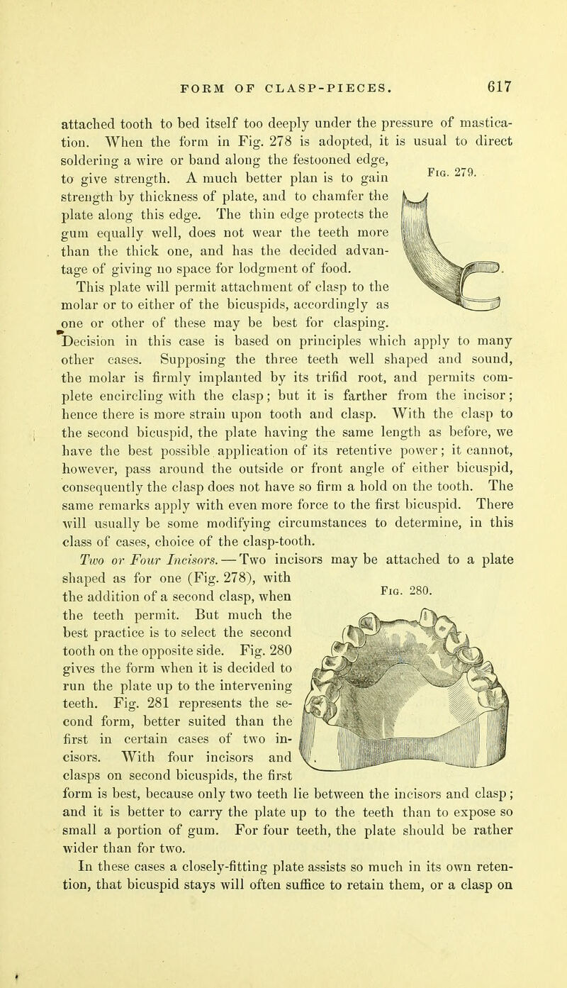 attached tooth to bed itself too deeply under the pressure of mastica- tion. When the form in Fig. 278 is adopted, it is usual to direct soldering a wire or band along the festooned edge, to give strength. A much better plan is to gain strength by thickness of plate, and to chamfer the plate along this edge. The thin edge protects the gum equally well, does not wear the teeth more than the thick one, and has the decided advan- tage of giving no space for lodgment of food. This plate will permit attachment of clasp to the molar or to either of the bicuspids, accordingly as one or other of these may be best for clasping. Decision in this case is based on principles which apply to many other cases. Supposing the three teeth well shaped and sound, the molar is firmly implanted by its trifid root, and permits com- plete encircling with the clasp; but it is farther from the incisor; hence there is more strain upon tooth and clasp. With the clasp to the second bicuspid, the plate having the same length as before, we have the best possible, application of its retentive power; it cannot, however, pass around the outside or front angle of either bicuspid, consequently the clasp does not have so firm a hold on the tooth. The same remarks apply with even more force to the first bicuspid. There will usually be some modifying circumstances to determine, in this class of cases, choice of the clasp-tooth. Two or Four Incisors. — Two incisors may be attached to a plate shaped as for one (Fig. 278), with the addition of a second clasp, when the teeth permit. But much the best practice is to select the second tooth on the opposite side. Fig. 280 gives the form when it is decided to run the plate up to the intervening teeth. Fig. 281 represents the se- cond form, better suited than the first in certain cases of two in- cisors. With four incisors and clasps on second bicuspids, the first form is best, because only two teeth lie between the incisors and clasp; and it is better to carry the plate up to the teeth than to expose so small a portion of gum. For four teeth, the plate should be rather wider than for two. In these cases a closely-fitting plate assists so much in its own reten- tion, that bicuspid stays will often suffice to retain them, or a clasp on