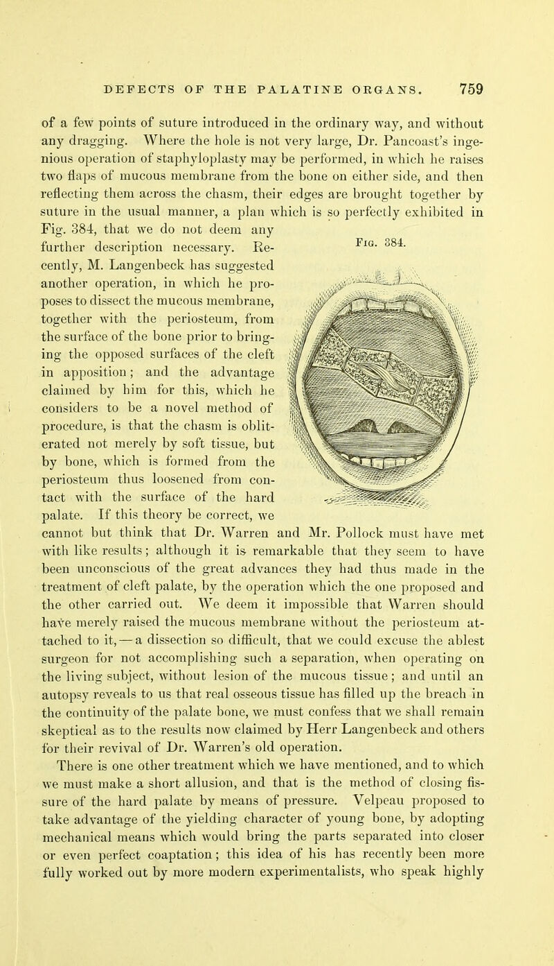 of a few points of suture introduced in the ordinary way, and without any dragging. Where the hole is not very large, Dr. Pancoast's inge- nious operation of staphyloplasty may be performed, in which he raises two flaps of mucous membrane from the bone on either side, and then reflecting them across the chasm, their edges are brought together by suture in the usual manner, a plan which is so perfectly exhibited in Fig. 384, that we do not deem any further description necessary. Re- cently, M. Langenbeck has suggested another operation, in which he pro- poses to dissect the mucous membrane, together with the periosteum, from the surface of the bone prior to bring- ing the opposed surfaces of the cleft in apposition; and the advantage claimed by him for this, which he considers to be a novel method of procedure, is that the chasm is oblit- erated not merely by soft tissue, but by bone, which is formed from the periosteum thus loosened from con- tact with the surface of the hard palate. If this theory be correct, we cannot but think that Dr. Warren and Mr. Pollock must have met with like results; although it is remarkable that they seem to have been unconscious of the great advances they had thus made in the treatment of cleft palate, by the operation which the one proposed and the other carried out. We deem it impossible that Warren should have merely raised the mucous membrane without the periosteum at- tached to it, —a dissection so difficult, that we could excuse the ablest surgeon for not accomplishing such a separation, when operating on the living subject, without lesion of the mucous tissue; and until an autopsy reveals to us that real osseous tissue has filled up the breach in the continuity of the palate bone, we must confess that we shall remain skeptical as to the results now claimed by Herr Langenbeck and others for their revival of Dr. Warren's old operation. There is one other treatment which we have mentioned, and to which we must make a short allusion, and that is the method of closing fis- sure of the hard palate by means of pressure. Velpeau proposed to take advantage of the yielding character of young bone, by adopting mechanical means which would bring the parts separated into closer or even perfect coaptation; this idea of his has recently been more fully worked out by more modern experimentalists, who speak highly