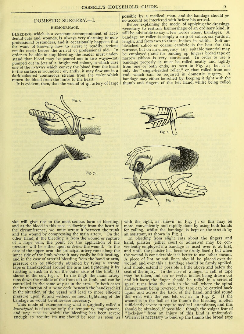 DOMESTIC SURGERY.—I. h.^;morrhage. Bleeding, which is a constant accompaniment of acci- dental cuts and wounds, is always very alarming to non- professional bystanders, and it occasionally happens that for want of knowing how to arrest it readily, serious results occur before the arrival of professional aid. In order to be able to stop bleeding the reader must under- stand that blood may be poured out in two ways—ist, pumped out in jets of a bright red colour, in which case one of the arteries which convey the blood from the heart to the surface is wounded ; or, 2ndly, it may flow out in a dark-coloured continuous stream from the veins which return the blood from the limbs to the heart. It is evident, then, that the wound of an artery of large possible by a medical man, and the bandage should on no account be interfered with before his arrival. Before explaining the mode of applying the dressings necessary to restrain haemorrhage of an ordinary kind, it will be advisable to say a few words about bandages. A bandage or roller is simply a strip of calico, six yards in length, and from two to three inches in width. Soft un- bleached calico or coarse cambric is the best for this purpose, but on an emergency any suitable material may be employed; and for binding up fingers broad tape or narrow ribbon is very convenient. In order to use a bandage properly it must be rolled neatly and tightly from one or both ends, as seen in Fig. 2 ; but it is only the “ single-headed roller,” or that rolled from one end, which can be required in domestic surgery. A bandage may either be rolled by keeping it tight with the thumb and fingers of the left hand, whilst being roUed size will give rise to the most serious form ot bleeding, and as the blood in this case is flowing from the heart to the circumference, we must arrest it between the trunk and the wound by compressing the main artery. On the other hand, if the bleeding is from the wound or rupture of a large vein, the point for the application of the pressure will be either upon or below the wound. In the case of the upper arm the principal artery runs along the inner side of the limb, where it may easily be felt beating, and in the case of arterial bleeding from the hand or arm, pressure can be efficiently obtained by tying a strong tape or handkerchief around the arm and tightening it by twisting a stick in it on the outer side of the limb, as shown in the cut. Fig. i. In the thigh the main artery runs down the middle of the front of the limb, and can be controlled in the same way as in the arm. In both cases the introduction of a wine cork beneath the handkerchief in the situation of the vessel will lead to more efficient pressure upon it, and without so much tightening of the bandage as would be otherwise necessary. This mode of extemporising what is surgically called a tourniquet, is of course only for temporary employment, and any case in which the bleeding has been severe enough to require its use should be seen as soon as with the right, as shown in Fig. 3 ; or this may be more conveniently and rapidly done by using both hands for rolling, whilst the bandage is kept on the stretch by an assistant, as shown in Fig. 4. In bleeding from slight cuts about the fingers and hand, plaister (either court or adhesive) may be con- veniently employed if a bandage is used over it at first, and until the plaister has become firmly fixed ; but when the wound is considerable it is better to use other means. A piece of lint or soft linen should be placed over the wound, and over this a bandage should be firmly applied, and should extend if possible a little above and below the seat of the injury. In the case of a finger a roll of tape may be taken, and ten or twelve inches being drawn out and left loose, the finger should be rolled in a series of spiral turns from the web to the nail, where the spiral arrangement being reversed, the tape can be carried back again and across the back of the hand, and tied round the wrist with the end left out as in Fig. 5. If the wound is in the ball of the thumb the bleeding is often sufficiently severe to require medical attendance, and this should be obtained, if possible ; though the vulgar fear of “lock-jaw” from an injury of this kind is unfounded. When it is necessary to bind up the thumb the broad tape